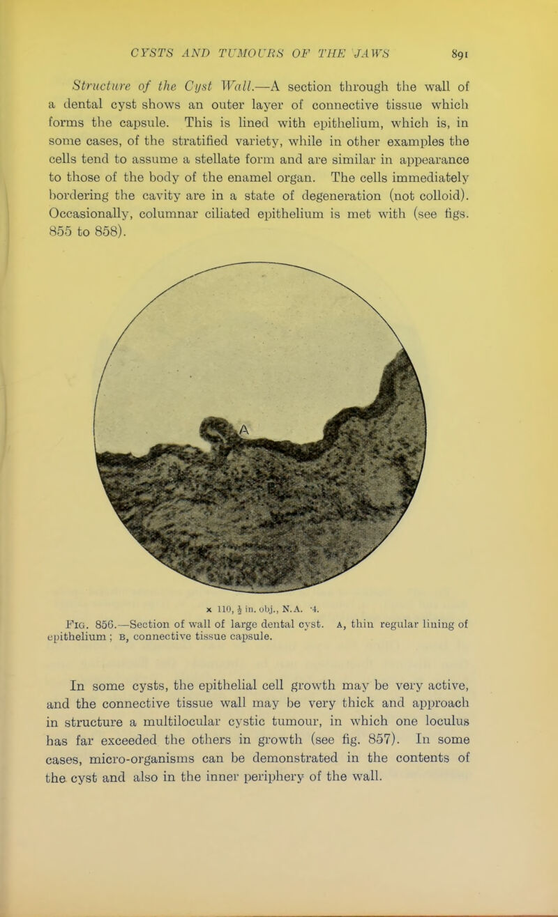 Structure of the Cyst Wall.—A section through the wall of a dental cyst shows an outer layer of connective tissue which forms the capsule. This is lined with epithelium, which is, in some cases, of the stratified variety, while in other examples the cells tend to assume a stellate form and are similar in appearance to those of the body of the enamel organ. The cells immediately bordering the cavity are in a state of degeneration (not colloid). Occasionally, columnar ciliated epithelium is met with (see figs. 855 to 858). x 110, h in. obj., N.A. ■}. Fig. 856.—Section of wall of large dental cyst. A, thin regular lining of epithelium ; b, connective tissue capsule. In some cysts, the epithelial cell growth may be very active, and the connective tissue wall may be very thick and approach in structure a multilocular cystic tumour, in which one loculus has far exceeded the others in growth (see fig. 857). In some cases, micro-organisms can be demonstrated in the contents of the cyst and also in the inner periphery of the wall.