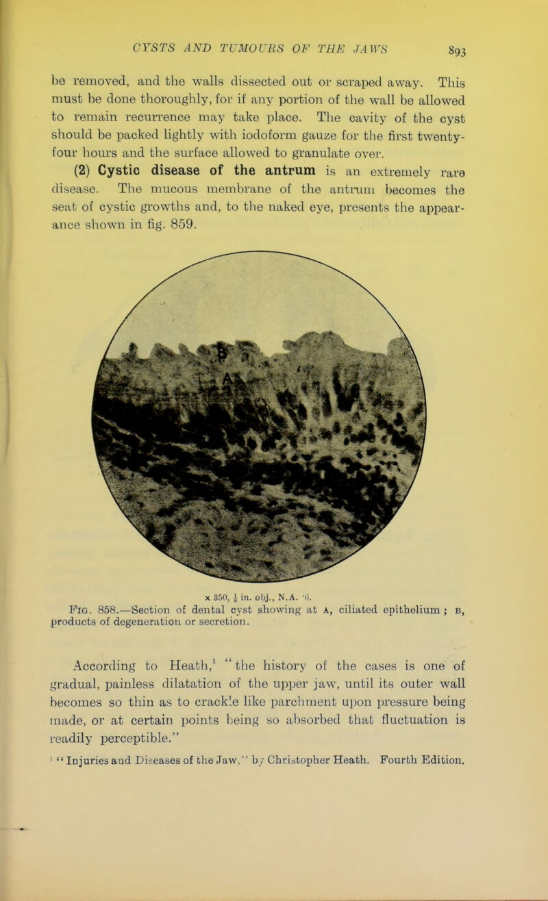 be removed, and the walls dissected out or scraped away. This must be done thoroughly, for if any portion of the wall be allowed to remain recurrence may take place. The cavity of the cyst should be packed lightly with iodoform gauze for the first twenty- four hours and the surface allowed to granulate over. (2) Cystic disease of the antrum is an extremely rare disease. The mucous membrane of the antrum becomes the seat of cystic growths and, to the naked eye, presents the appear- ance shown in fig. 859. x 350, J in. obj., N.A. '(>. Fig. 858.—Section of dental cyst showing at a, ciliated epithelium ; B, products of degeneration or secretion. According to Heatb,1  the history of the cases is one of gradual, painless dilatation of the upper jaw, until its outer wall becomes so thin as to crackle like parchment upon pressure being made, or at certain points being so absorbed that fluctuation is readily perceptible. 1  Id juries and Diseases of the Jaw, by Christopher Heath. Fourth Edition.