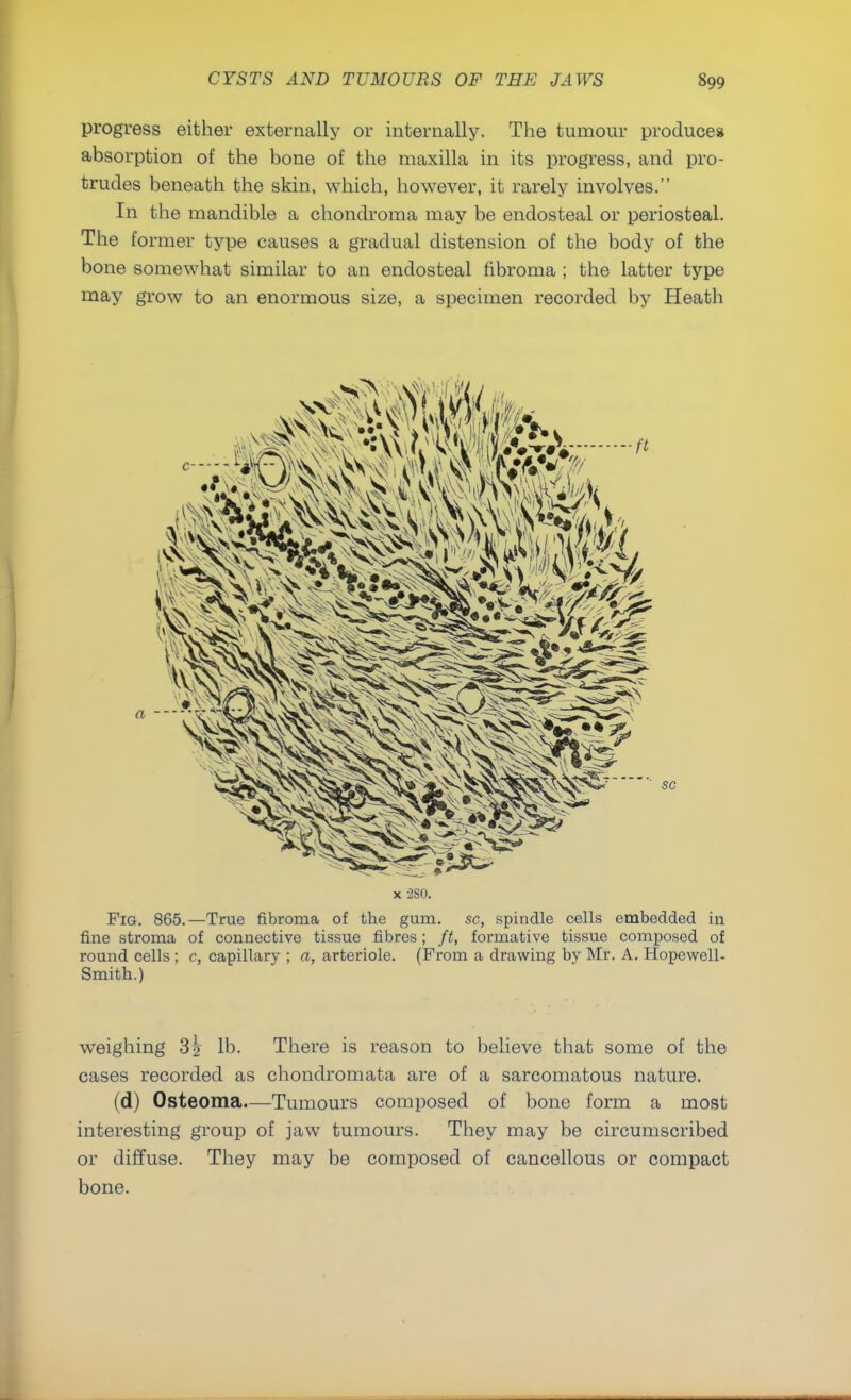 progress either externally or internally. The tumour produces absorption of the bone of the maxilla in its progress, and pro- trudes beneath the skin, which, however, it rarely involves. In the mandible a chondroma may be endosteal or periosteal. The former type causes a gradual distension of the body of the bone somewhat similar to an endosteal fibroma ; the latter type may grow to an enormous size, a specimen recorded by Heath x 2S0. Fig. 865.—True fibroma of the gum. sc, spindle cells embedded in fine stroma of connective tissue fibres; ft, formative tissue composed of round cells ; c, capillary ; a, arteriole. (From a drawing by Mr. A. Hopewell- Smith.) weighing 3j> lb. There is reason to believe that some of the cases recorded as chondromata are of a sarcomatous nature. (d) Osteoma.—Tumours composed of bone form a most interesting group of jaw tumours. They may be circumscribed or diffuse. They may be composed of cancellous or compact bone.