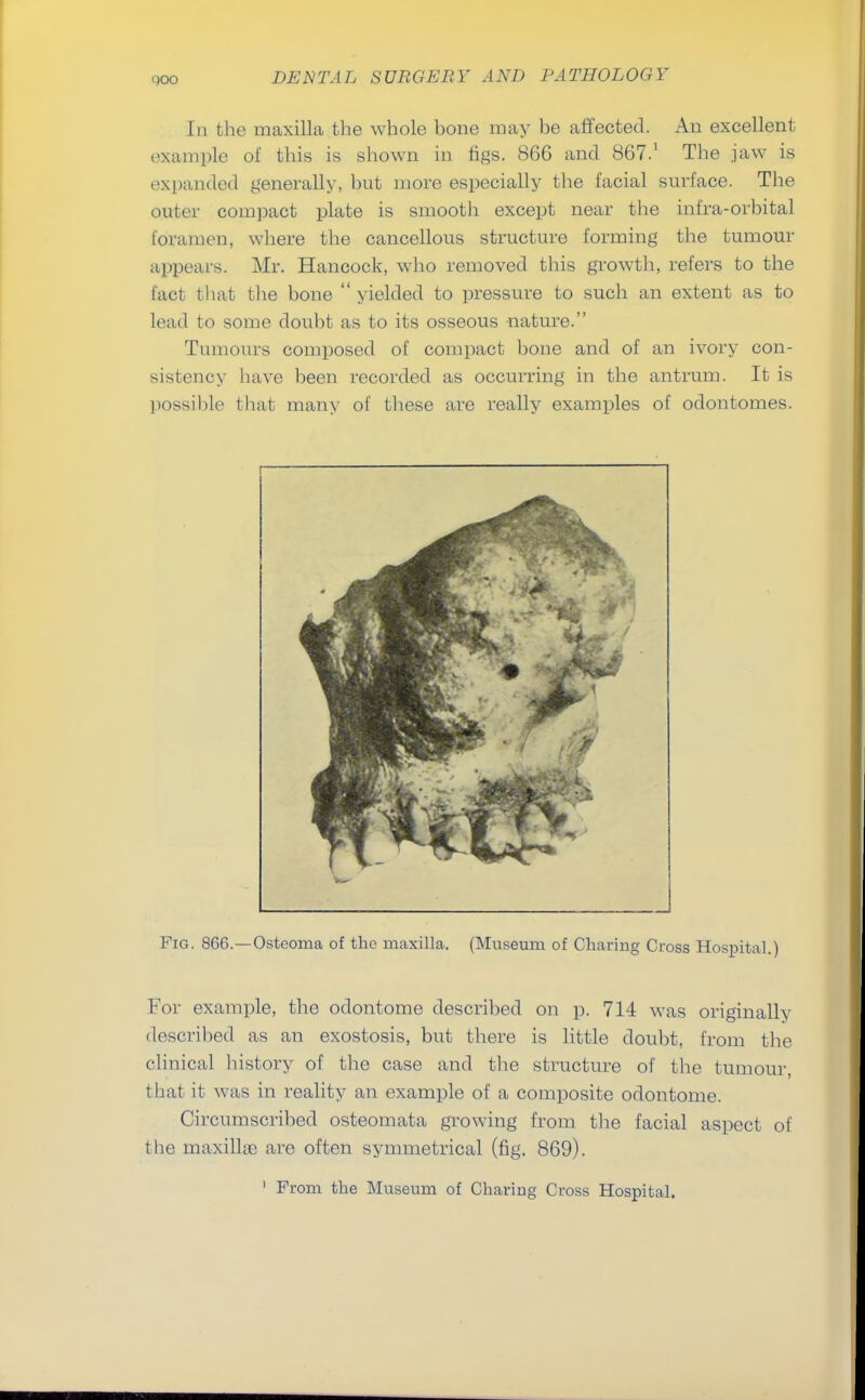 In the maxilla the whole hone may he affected. An excellent example of this is shown in figs. 866 and 867.1 The jaw is expanded generally, but more especially the facial surface. The outer compact plate is smooth except near the infra-orbital foramen, where the cancellous structure forming the tumour appears. Mr. Hancock, who removed this growth, refers to the fact that the bone yielded to pressure to such an extent as to lead to some doubt as to its osseous -nature. Tumours composed of compact bone and of an ivory con- sistency have been recorded as occurring in the antrum. It is possible that many of these are really examples of odontomes. Fig. 866.—Osteoma of the maxilla. (Museum of Charing Cross Hospital.) For example, the odontome described on p. 714 was originally described as an exostosis, but there is little doubt, from the clinical history of the case and the structure of the tumour, that it was in reality an example of a composite odontome. Circumscribed osteomata growing from the facial aspect of the maxillae are often symmetrical (fig. 869). 1 From the Museum of Chariug Cross Hospital.