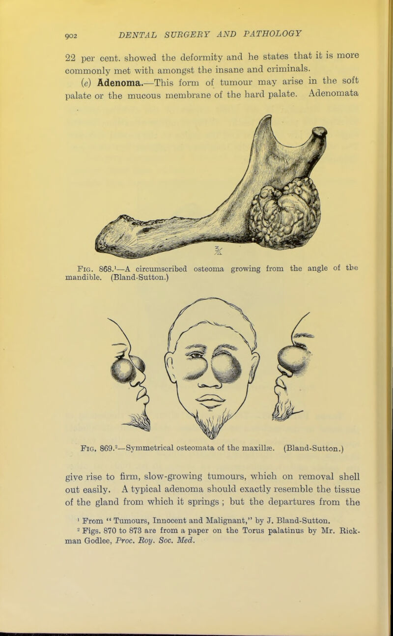 22 per cent, showed the deformity and he states that it is more commonly met with amongst the insane and criminals. (e) Adenoma.—This form of tumour may arise in the soft palate or the mucous membrane of the hard palate. Adenomata Fig. 868.1—A circumscribed osteoma growing from the angle of the mandible. (Bland-Sutton.) Pig. 869.2—Symmetrical osteomata of the maxillse. (Bland-Sutton.) give rise to firm, slow-growing tumours, which on removal shell out easily. A typical adenoma should exactly resemble the tissue of the gland from which it springs ; but the departures from the 1 From Tumours, Innocent and Malignant, by J. Bland-Sutton. 2 Figs. 870 to 873 are from a paper on the Torus palatinus by Mr. Rick- man Godlee, Proc. Roy. Soc. Med.