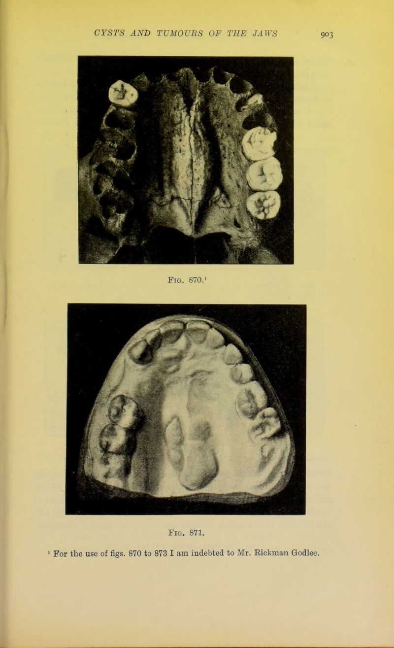 Fig. 871. 1 For the use of figs. 870 to 873 I am indebted to Mr. Rickman Godlee.