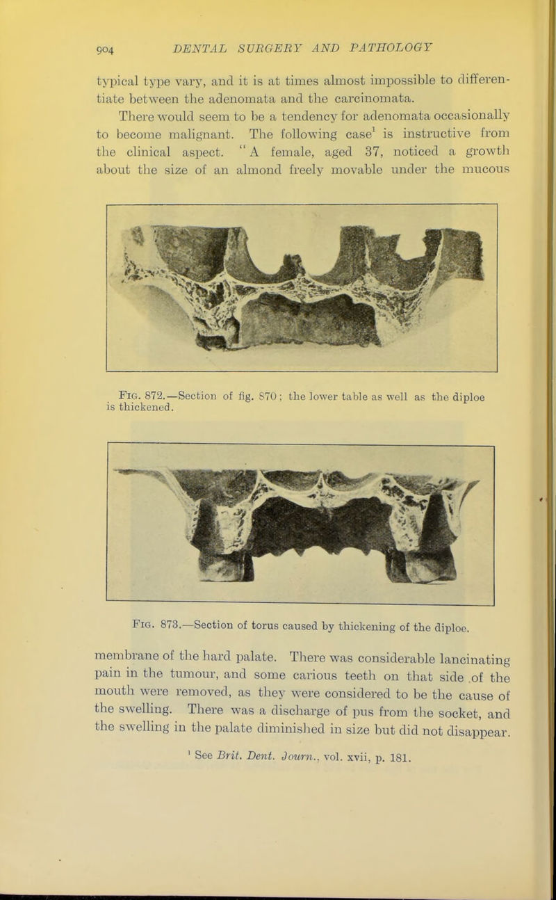 typical type vary, and it is at times almost impossible to differen- tiate between the adenomata and the carcinomata. There would seem to be a tendency for adenomata occasionally to become malignant. The following case1 is instructive from the clinical aspect. A female, aged 37, noticed a growth about the size of an almond freely movable under the mucous Fig. 873.—Section of torus caused by thickening of the diploe. membrane of the hard palate. There was considerable lancinating pain in the tumour, and some carious teeth on that side of the mouth were removed, as they were considered to be the cause of the swelling. There was a discharge of pus from the socket, and the swelling in the palate diminished in size but did not disappear. 1 See Brit. Dent. Journ.. vol. xvii, p. 181.