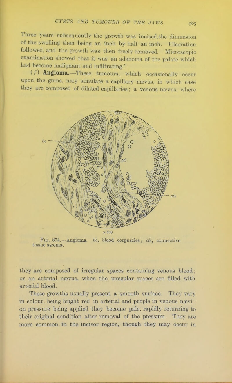 905 Three years subsequently the growth was incised.the dimension of the swelling then being an inch by half an inch. Ulceration followed, and the growth was then freely removed. Microscopic examination showed that it was an adenoma of the palate which had become malignant and infiltrating. (/) Angioma.—These tumours, which occasionally occur upon the gums, may simulate a capillary nsevus, in which case they are composed of dilated capillaries; a venous nasvus, where they are composed of irregular spaces containing venous blood ; or an arterial naevus, when the irregular spaces are filled with arterial blood. These growths usually present a smooth surface. They vary in colour, being bright red in arterial and purple in venous naevi ; on pressure being applied they become pale, rapidly returning to their original condition after removal of the pressure. They are more common in the incisor region, though they may occur in