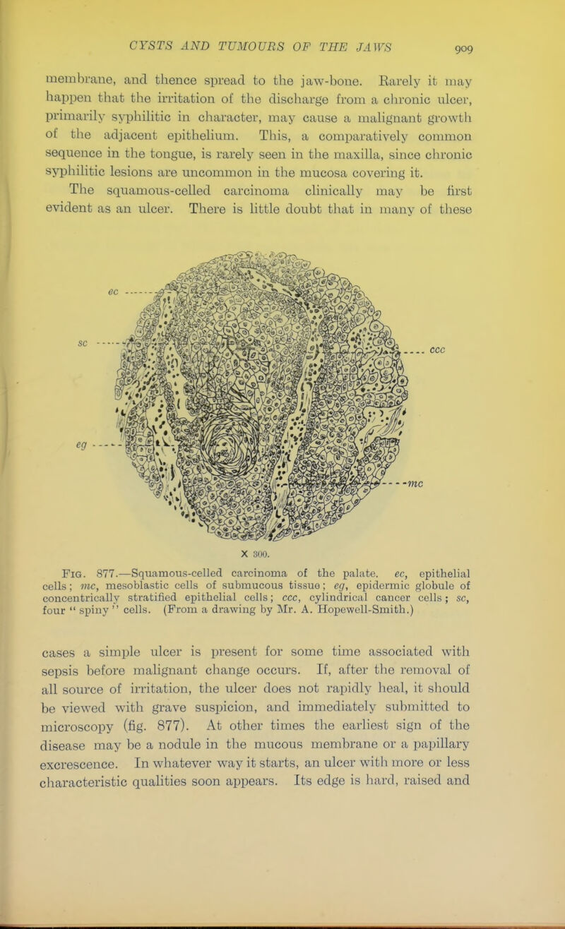 membrane, and thence spread to the jaw-bone. Barely it may happen that the irritation of the discharge from a chronic nicer, primarily syphilitic in character, may cause a malignant growth of the adjacent epithelium. This, a comparatively common sequence in the tongue, is rarely seen in the maxilla, since chronic syphilitic lesions are uncommon in the mucosa covering it. The squamous-celled carcinoma clinically may be first evident as an ulcer. There is little doubt that in many of these ccc x soo. Fig. 877.—Squamous-celled carcinoma of the palate. ec, epithelial cells; mc, mesoblastic cells of submucous tissue; eg, epidermic globule of concentrically stratified epithelial cells; ccc, cylindrical cancer cells; sc, four  spiny  cells. (From a drawing by Mr. A. Hopewell-Smith.) cases a simple ulcer is present for some time associated with sepsis before malignant change occurs. If, after the removal of all source of irritation, the ulcer does not rapidly heal, it should be viewed with grave suspicion, and immediately submitted to microscopy (fig. 877). At other times the earliest sign of the disease may be a nodule in the mucous membrane or a papillary excrescence. In whatever way it starts, an ulcer with more or less characteristic qualities soon appears. Its edge is hard, raised and