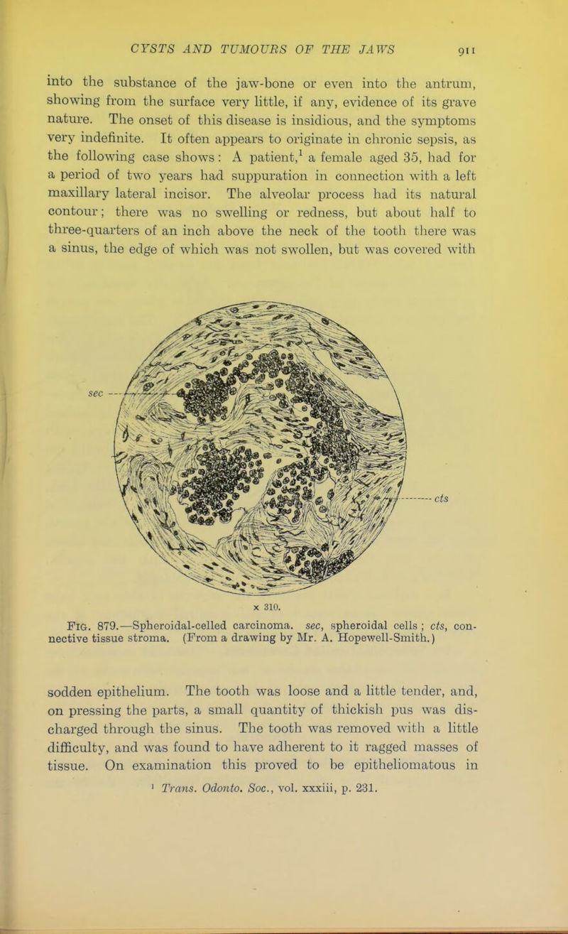 into the substance of the jaw-bone or even into the antrum, showing from the surface very little, if any, evidence of its grave nature. The onset of this disease is insidious, and the symptoms very indefinite. It often appears to originate in chronic sepsis, as the following case shows: A patient,1 a female aged 35, had for a period of two years had suppuration in connection with a left maxillary lateral incisor. The alveolar process had its natural contour; there was no swelling or redness, but about half to three-quarters of an inch above the neck of the tooth there was a sinus, the edge of which was not swollen, but was covered with cts Fig. 879.—Spheroidal-celled carcinoma, sec, spheroidal cells ; cts, con- nective tissue stroma. (From a drawing by Mr. A. Hopewell-Smith.) sodden epithelium. The tooth was loose and a little tender, and, on pressing the parts, a small quantity of thickish pus was dis- charged through the sinus. The tooth was removed with a little difficulty, and was found to have adherent to it ragged masses of tissue. On examination this proved to be epitheliomatous in 1 Trans. Odonto. Soc, vol. xxxiii, p. 231.