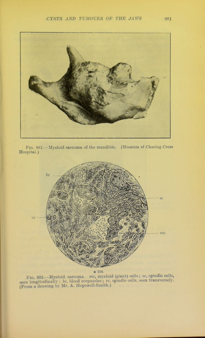 x 250. Fig 882—Myeloid sarcoma, vie, myeloid (giant) cells ; sc, spindle cells, seen longitudinally ; be, blood corpuscles ; rc, spindle cells, seen transversely. (From a drawing by Mr. A. Hopewell-Smith.)