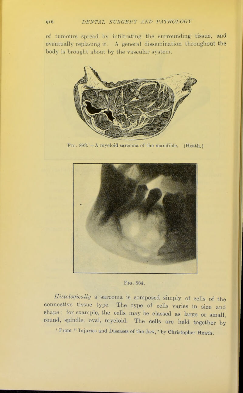 of tumours spread by infiltrating the surrounding tissue, and eventually replacing it. A general dissemination throughout the body is brought about by the vascular system. Fig. 883.'—A myeloid sarcoma of the mandible. (Heath.) Fig. 884. Histologically a sarcoma is composed simply of cells of the connective tissue type. The type of cells varies in size and shape; for example, the cells may be classed as large or small, round, spindle, oval, myeloid. The cells are held together by 1 From  Injuries and Diseases of the Jaw, by Christopher Heath.