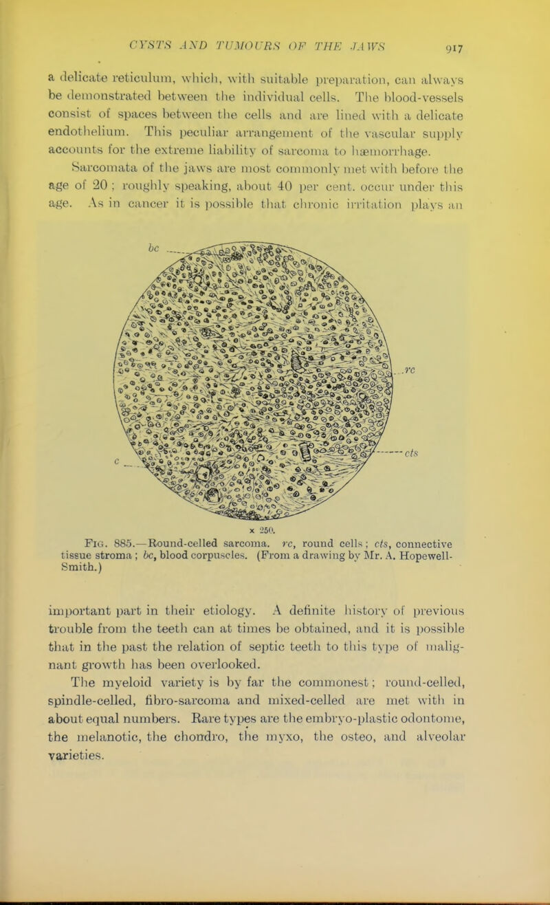 a delicate reticulum, which, with suitable preparation, can always be demonstrated between the individual cells. The blood-vessels consist of spaces between the cells and are lined with a delicate endothelium. This peculiar arrangement of the vascular supply accounts for the extreme liability of sarcoma to haemorrhage. Sarcomata of the jaws are most commonly met with before the age of 20 ; roughly speaking, about 40 per cent, occur under this age. As in cancer it is possible that chronic irritation plays an x _'5<'. Fig. 885.—Round-celled sarcoma, rc, round cells; cts, connective tissue stroma ; be, blood corpuscles. (From a drawing by Mr. A. Hopewell- Smith.) important part in their etiology. A definite history of previous trouble from the teeth can at times be obtained, and it is possible that in the past the relation of septic teeth to this type of malig- nant growth has been overlooked. The myeloid variety is by far the commonest; round-celled, spindle-celled, fibro-sarcoma and mixed-celled are met with in about equal numbers. Rare types are the embryo-plastic odontome, the melanotic, the chondro, the myxo, the osteo, and alveolar varieties.