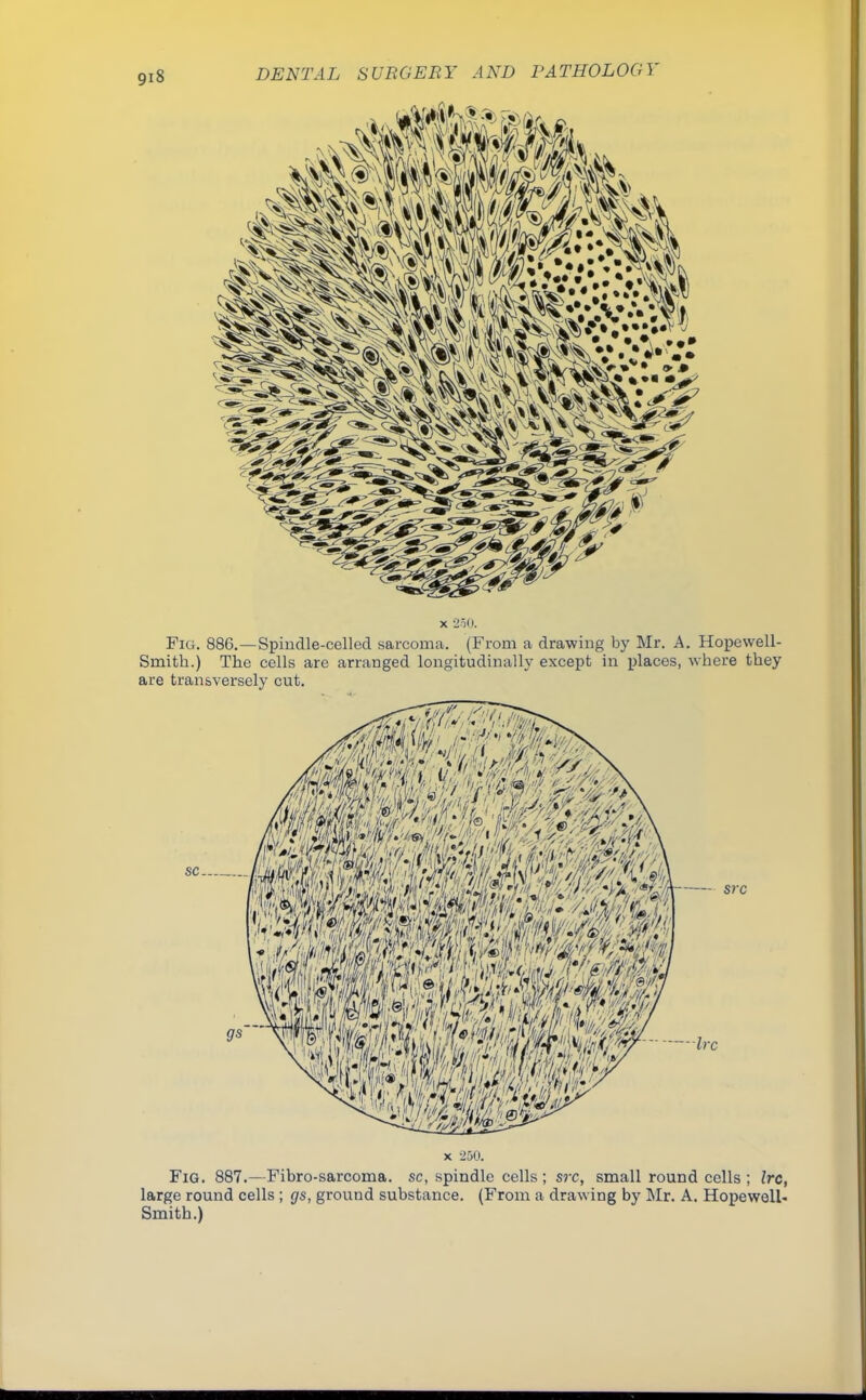 x 250. Fig. 886.—Spindle-celled sarcoma,. (From a drawing by Mr. A. Hopewell- Smith.) The cells are arranged longitudinally except in places, where they are transversely cut. x 250. Fig. 887.—Fibro-sarcoma. sc, spindle cells ; src, small round cells ; Ire, large round cells ; gs, ground substance. (From a drawing by Mr. A. Hopewell- Smith.)