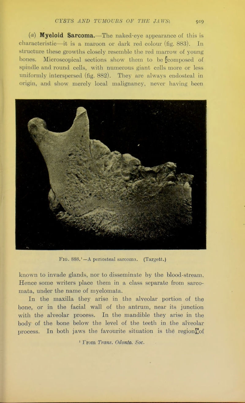 (a) Myeloid Sarcoma.—The naked-eye appearance of this is characteristic—it is a maroon or dark red colour (fig. 883). In structure these growths closely resemble the red marrow of young hones. Microscopical sections show them to be ^composed of spindle and round cells, with numerous giant cells more or less uniformly interspersed (fig. 882). They are always endosteal in Fig. 888.'—A periosteal sarcoma. (Targett.) known to invade glands, nor to disseminate by the blood-stream. Hence some writers place them in a class separate from sarco- mata, under the name of myelomata. In the maxilla they arise in the alveolar portion of the bone, or in the facial wall of the antrum, near its junction with the alveolar process. In the mandible they arise in the body of the bone below the level of the teeth in the alveolar process. In both jaws the favourite situation is the regionJIof