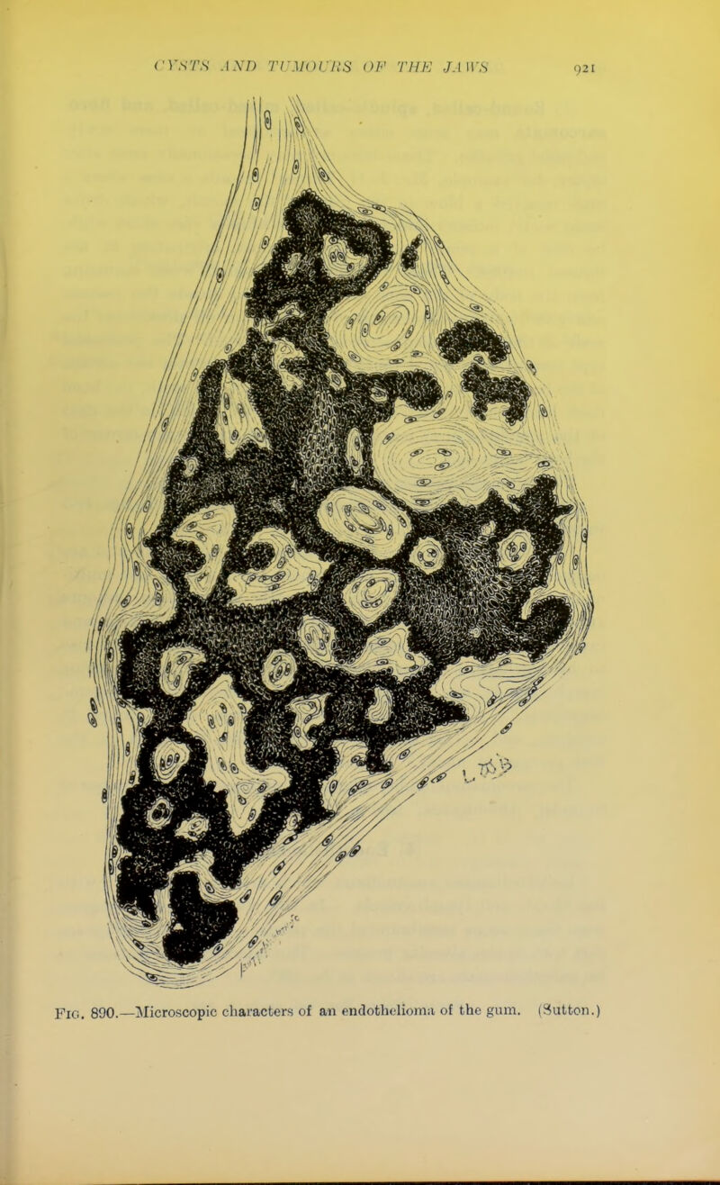 Fig. 890.—Microscopic characters of an endothelioma of the gum. (Sutton.)