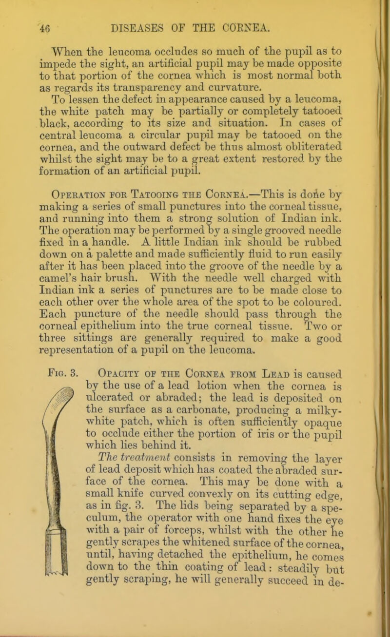 When the leucoma occludes so mucli of the pupil as to impede the sight, an artificial pupil may be made opposite to that portion of the cornea which is most normal both as regards its transparency and curvature. To lessen the defect in appearance caused by a leucoma, the white patch may be partially or completely tatooed black, according to its size and situation. In cases of central leucoma a circular pupil may be tatooed on the cornea, and the oiitward defect be thus almost obliterated whilst the sight may be to a great extent restored by the formation of an artificial pupil. Operation for Tatooing the Cornea.—This is doAe by making a series of small punctures into the corneal tissue, and running into them a strong solution of Indian ink. The operation may be performed b}^ a single grooved needle fixed in a handle. A little Indian ink should be rubbed down on a palette and made sufiiciently fluid to I'un easily after it has been placed into the groove of the needle by a camel's hair brush. With the needle well charged with Indian ink a series of punctures are to be made close to each other over the whole area of the spot to be coloured. Each puncture of the needle should pass through the corneal epithehum into the true corneal tissue. Two or three sittings are generally required to make a good representation of a pupil on the leucoma. Fig. 3. Opacity of the Cornea from Lead is caused by the use of a lead lotion when the cornea is ulcerated or abraded; the lead is deposited on the surface as a carbonate, producing a milky- white patch, which is often sufficiently opaque to occlude either the portion of iris or the pupil which lies behind it. The treatment consists in removing the laver of lead deposit which has coated the abraded sur- face of the cornea. This may be done with a small knife curved convexly on its cutting ed^e, as in fig. 3. The Hds being separated by a spe- culum, the operator with one hand fixes the eye with a pair of forceps, whilst with the other he gently scrapes the whitened surface of the cornea, until, having detached the epithelium, he conies down to the thin coating of lead: steadily but gently scraping, he will generally succeed in de-