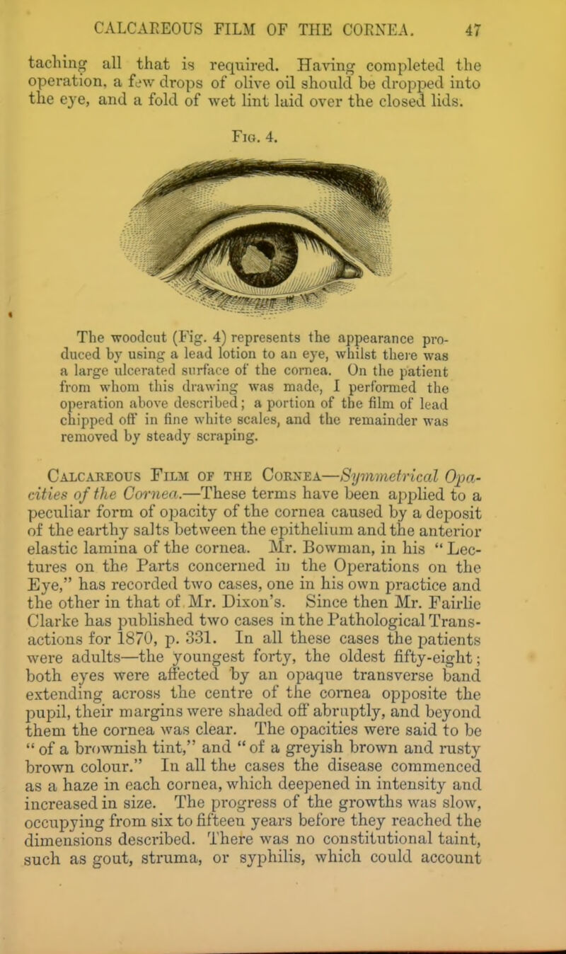 taching all that is required. Having completed the operation, a f^'w drops of olive oil should be dropped into the eye, and a fold of wet lint laid over the closed lids. Fia. 4. The woodcut (Fig. 4) represents the appearance pro- duced by using a lead lotion to an eye, whilst there was a large ulcerated surface of the comea. On tlie patient from whom this drawing was made, I performed the operation above described; a portion of the film of lead chipped oft' in fine white scales, and the remainder was removed by steady scraping. Calcareous Film of the Cornea—Symmetrical Oim- cities of the Cornea.—These terms have been applied to a peculiar form of opacity of the cornea caused by a deposit of the earthy salts between the epithelium and the anterior elastic lamina of the cornea. Mr. Bowman, in his  Lec- tures on the Parts concerned in the Ojierations on the Eye, has recorded two cases, one in his own practice and the other in that of Mr. Dixon's. Since then Mr. Fairlie Clarke has published two cases in the Pathological Trans- actions for 1870, p. 331. In all these cases the patients were adults—the youngest forty, the oldest fifty-eight; both eyes were affected by an opaque transverse band extending across the centre of the cornea opposite the l^upil, their margins were shaded off abruptly, and beyond them the cornea was clear. The opacities were said to be  of a brownish tint, and  of a greyish brown and rusty brown colour. In all the cases the disease commenced as a haze in each cornea, which deepened in intensity and increased in size. The progress of the growths was slow, occupying from six to fifteen years before they reached the dimensions desciibed. There was no constitutional taint, such as gout, struma, or syphilis, which could account