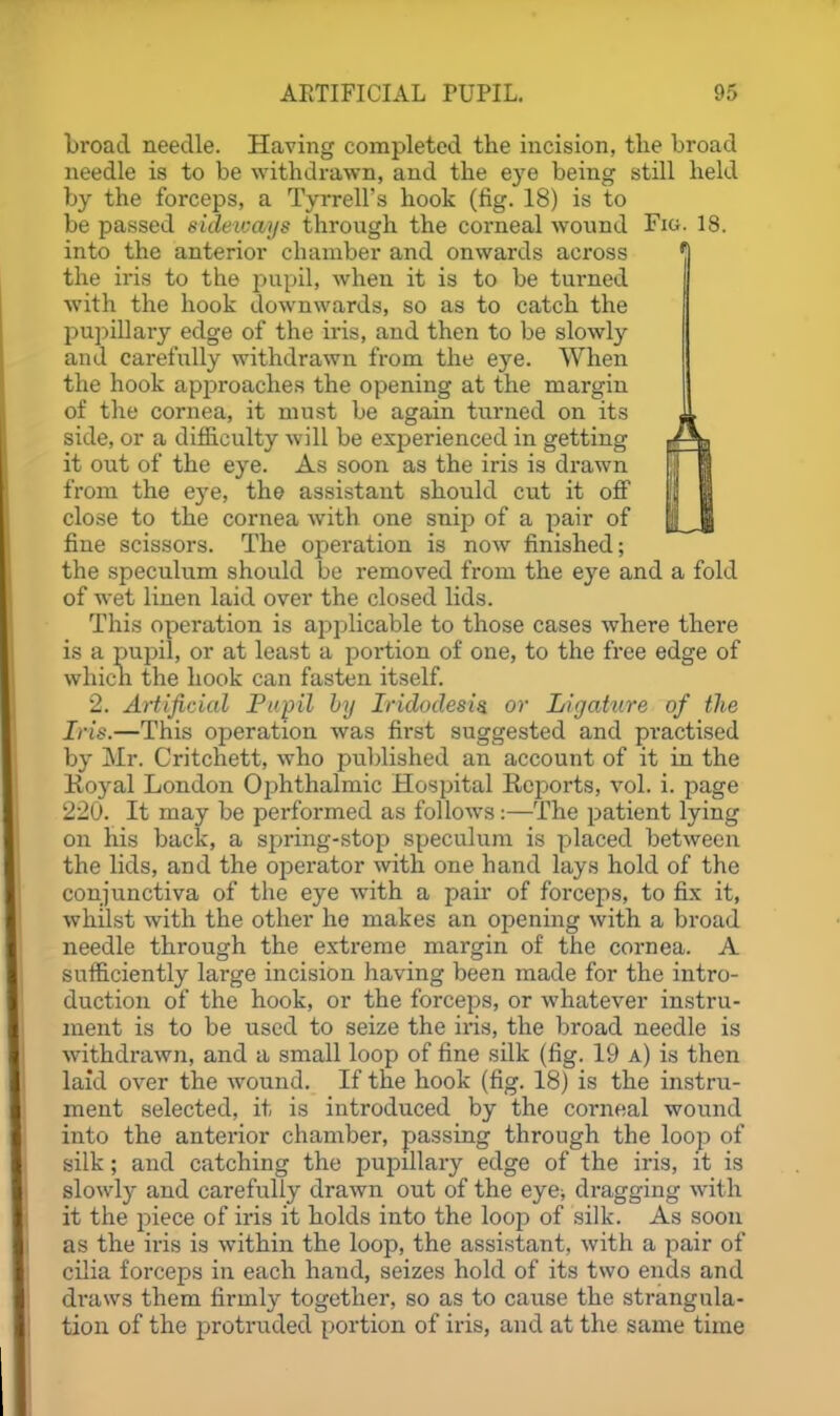 broad needle. Having completed the incision, tlie broad needle is to be withdrawn, and the eye being still held by the forceps, a Tyrrell's hook (tig. 18) is to be passed sideivays through the corneal wound Fig. 18. into the anterior chamber and onwards across the iris to the pupil, when it is to be turned with the hook downwards, so as to catch the pu])illary edge of the iris, and then to be slowl}^ and carefully withdrawn from the eye. When the hook approaches the opening at the margin of the cornea, it must be again turned on its side, or a difficulty will be experienced in getting it out of the eye. As soon as the iris is drawn from the eye, the assistant should cut it off close to the cornea with one snip of a pair of fine scissors. The operation is now finished; the speculum should bo removed from the eye and a fold of wet linen laid over the closed lids. This operation is applicable to those cases where there is a pupil, or at least a portion of one, to the free edge of which the hook can fasten itself 2. Artificial Papil by Iridodesi^ or Ligahire of the Iris.—This operation was first suggested and pi*actised by Mr. Critchett, who published an account of it in the Koyal London Ophthalmic Hospital Reports, vol. i. page 220. It may be performed as follows:—The patient lying on his back, a spring-stop speculum is placed between the lids, and the ojjerator with one hand lays hold of the conjunctiva of the eye with a pair of forceps, to fix it, whilst with the other he makes an opening with a broad needle through the extreme margin of the cornea. A sufficiently large incision having been made for the intro- duction of the hook, or the forceps, or whatever instru- ment is to be used to seize the iris, the broad needle is withdrawn, and a small loop of fine silk (fig. 19 a) is then laid over the wound. If the hook (fig. 18) is the instru- ment selected, it is introduced by the corneal wound into the anterior chamber, passing through the loop of silk; and catching the pupillary edge of the iris, it is slowly and carefully drawn out of the eye^ dragging with it the piece of iris it holds into the loop of silk. As soon as the iris is within the loop, the assistant, with a pair of cilia forceps in each hand, seizes hold of its two ends and draws them firmly together, so as to cause the strangula- tion of the protruded portion of iris, and at the same time