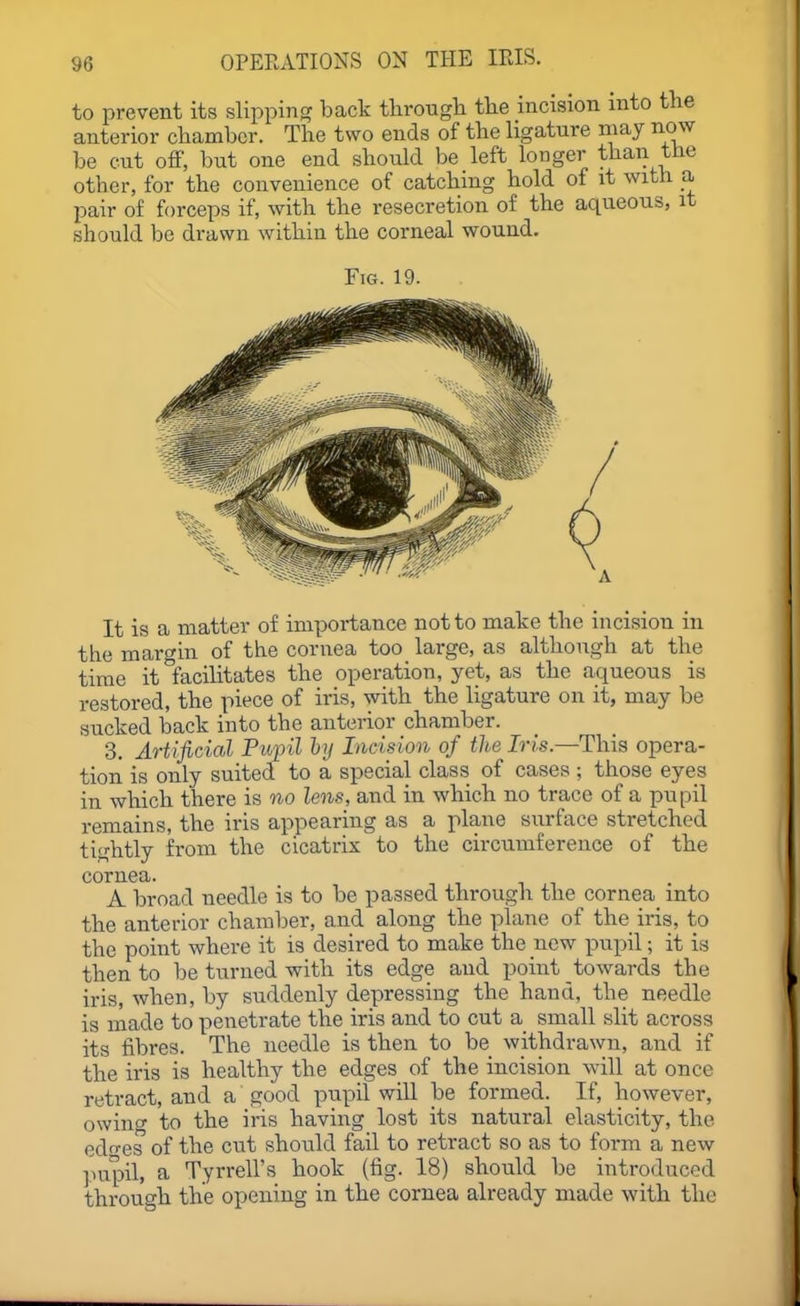 to prevent its slipping back throngli the incision into the anterior chamber. The two ends of the ligature may now be cut ofi; but one end should be left longer than the other, for the convenience of catching hold of it with a. pair of forceps if, with the resecretion of the aqueous, it should be drawn within the corneal wound. Fig. 19. It is a matter of importance not to make the incision in the margin of the cornea too large, as although at the time it facilitates the operation, yet, as the aqueous is restored, the piece of iris, with the ligature on it, may be sucked back into the anterior chamber. 3. Artificial Fuf il by Incision of the Iris.—This opera- tion is only suited to a special class of cases ; those eyes in which there is no lens, and in which no trace of a pupil remains, the iris appearing as a plane surface stretched tightly from the cicatrix to the circumference of the cornea. A broad needle is to be passed through the cornea into the anterior chamber, and along the plane of the iris, to the point where it is desired to make the new pupil; it is then to be turned with its edge and point towards the iris, when, by suddenly depressing the hand, the needle is made to penetrate the iris and to cut a small slit across its fibres. The needle is then to be withdrawn, and if the iris is healthy the edges of the incision will at once retract, and a good pupil will be formed. If, however, owino- to the iris having lost its natural elasticity, the edn-es of the cut should fail to retract so as to form a new pupil, a Tyrrell's hook (fig. 18) should be introduced through the opening in the cornea already made with the