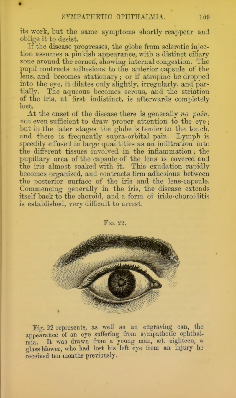 its work, but the same symptoms shortly reappear and oblige it to desist. It the disease progresses, the globe from sclerotic injec- tion assumes a pinkish appearance, with a distinct ciUary zone around the cornea, showing internal congestion. The pupil contracts adhesions to the anterior capsule of the lens, and becomes stationary; or if atrojiine be dropped into the eye, it dilates only slightly, irregularly, and par- tially. The aqueous becomes serous, and the sti-iation of the iris, at first indistinct, is afterwards comj)letely lost. At the onset of the disease there is generally no pain, not even sufficient to draw proper attention to the eye; but in the later stages the globe is tender to the touch, and there is frequently supra-orbital pain. Lymph is speedily effused in large quantities as an infiltration into the different tissues involved in the inflammation; the pupillary area of the capsule of the lens is covered and the iris almost soaked with it. This exudation rapidly becomes organized, and contracts firm adhesions between the posterior surface of the iris and the lens-capsule. Commencing generally in the iris, the disease extends itself back to the choroid, and a form of irido-choroiditis is established, very difficult to an*est. Fjg. 22. Fig. 22 represents, as well as an engraving can, the appearance of an eye suffering from sympathetic ophthal- mia. It was drawn from a young man, ajt. eighteen, a glass-blower, who had lost his left eye from an injury he received ten months previously.