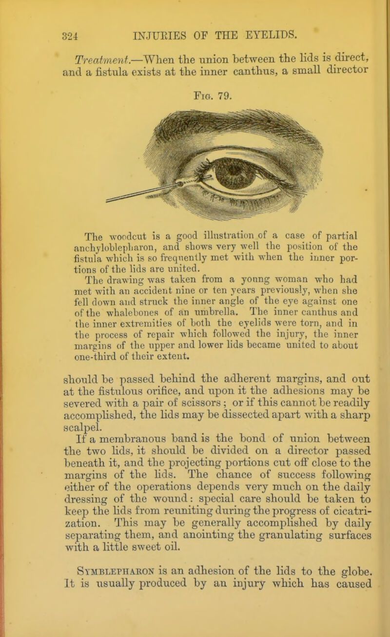 Treatment.—\Yhen the union between the lids is direct, and a fistula exists at the inner canthus, a small director The Avoodcut is a good illustration of a case of partial anchjloblepliaron, and shows very well the position of the fistula which is so frequently met with when the iuncr por- tions of the hds are united. The drawing was taken from a yonng woman who had met with an accident nine or ten years previously, when sho fell down and struck the inner angle of the eye against one of the whalebones of an nnibrella. The inner canthns and the inner extremities of both the eyelids were torn, and in the process of repair which followed the injury, the inner margins of the upper and lower lids became united to about one-third of their extent. should be passed behind the adherent margins, and out at the fistulous orifice, and upon it the adhesions may be severed with a pair of scissors ; or if this cannot be readily- accomplished, the lids may be dissected apart with a sharp scalpel. If a membranous band is the bond of union between the two lids, it should be divided on a director passed beneath it, and the projecting portions cut ofi close to the margins of the lids. The chance of success following either of the operations depends very much on the daily dressing of the wound: special care should be taken to keep the hds from reuniting during the progress of cicatri- zation. This may be generally accomplished by daily separating them, and anointing the granulating surfaces with a little sweet oil. SvMBLEPiiAKON is an adhesion of the lids to the globe. Jt is usually produced by an injury which has caused Fig. 79.
