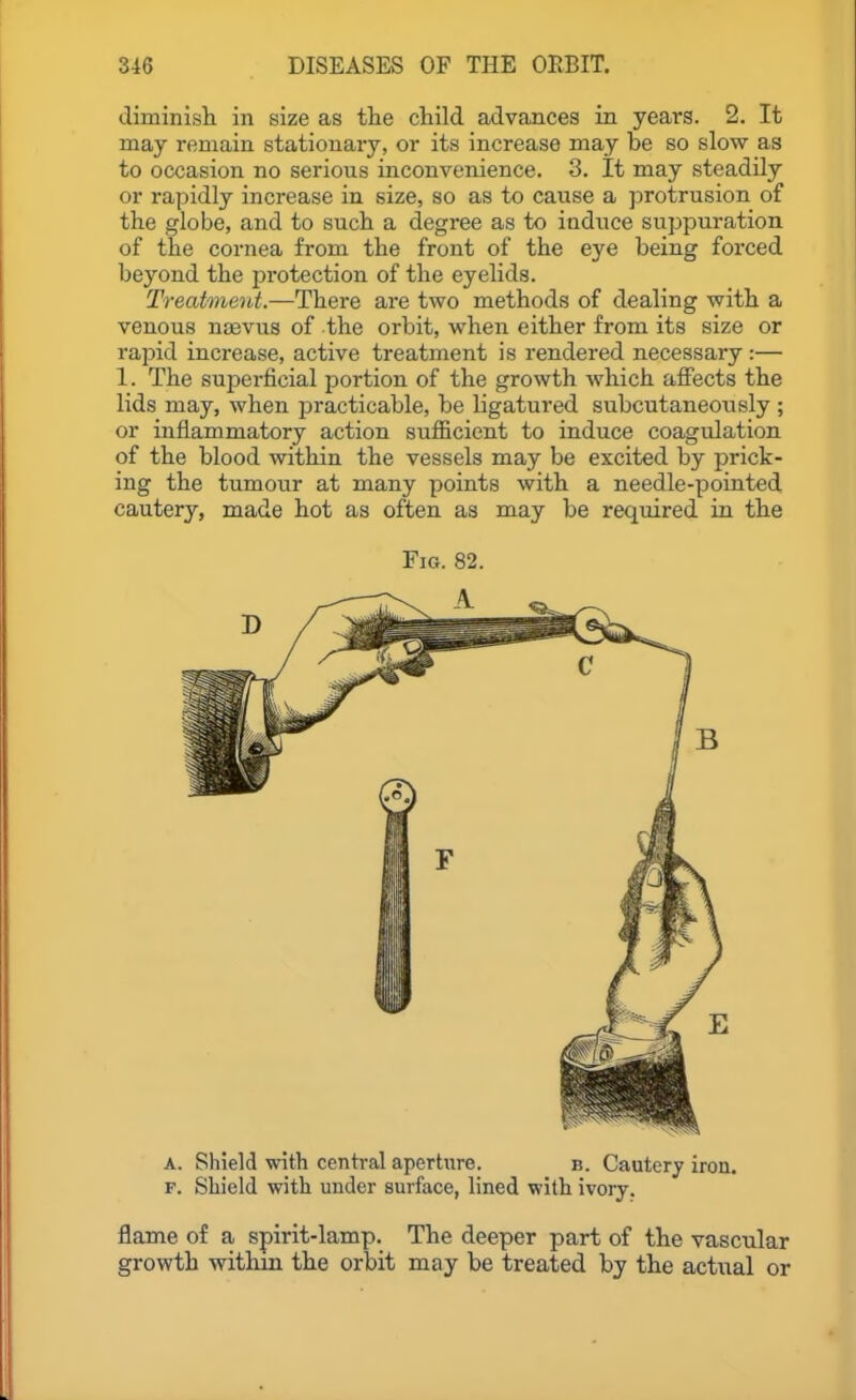 diminish, in size as the child advances in years. 2. It may remain stationary, or its increase may be so slow as to occasion no serious inconvenience. 3. It may steadily or rapidly increase in size, so as to cause a jjrotrusion of the globe, and to such a degree as to induce suppuration of the cornea from the front of the eye being forced beyond the protection of the eyelids. Treatment.—There are two methods of dealing with a venous ntevus of the orbit, when either from its size or rapid increase, active treatment is rendered necessary :— 1. The superficial portion of the growth which affects the lids may, when practicable, be ligatured subcutaneously ; or inflammatory action sufficient to induce coagulation of the blood within the vessels may be excited by prick- ing the tumour at many points with a needle-pointed cautery, made hot as often as may be required in the Fig. 82. A. Shield with central aperttire. b. Cautery iron. F. Shield with under surface, lined with ivory. flame of a spirit-lamp. The deeper part of the vascular growth withm the orbit may be treated by the actual or
