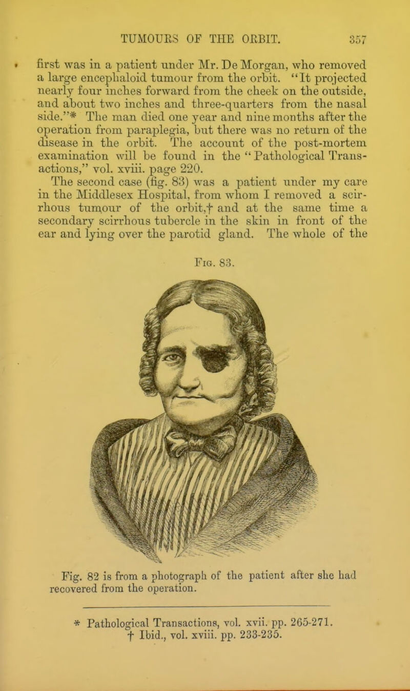 first was in a patient under Mr. De Morgan, who removed a large enceplialoid tumour from the orbit. It projected nearly four inches forward from the cheek on the outside, and about two inches and three-quarters from the nasal side.* The man died one year and nine months after the operation from paraplegia, but there was no return of the disease in the orbit. The account of the post-mortem examination will be found in the Pathological Trans- actions, vol. xviii. page 220. The second case (tig. 83) was a patient xmder my care in the Middlesex Hospital, from whom I removed a scir- rhous tumour of the orbit.f and at the same time a secondary scirrhous tubercle in the skin in front of the ear and lying over the parotid gland. The whole of the Fig. 83. Fig. 82 is from a photograph of the patient after she had recovered from the operation. * Pathological Transactions, vol. xvii. pp. 265-271. t Ibid., vol. xviii. pp. 233-235.
