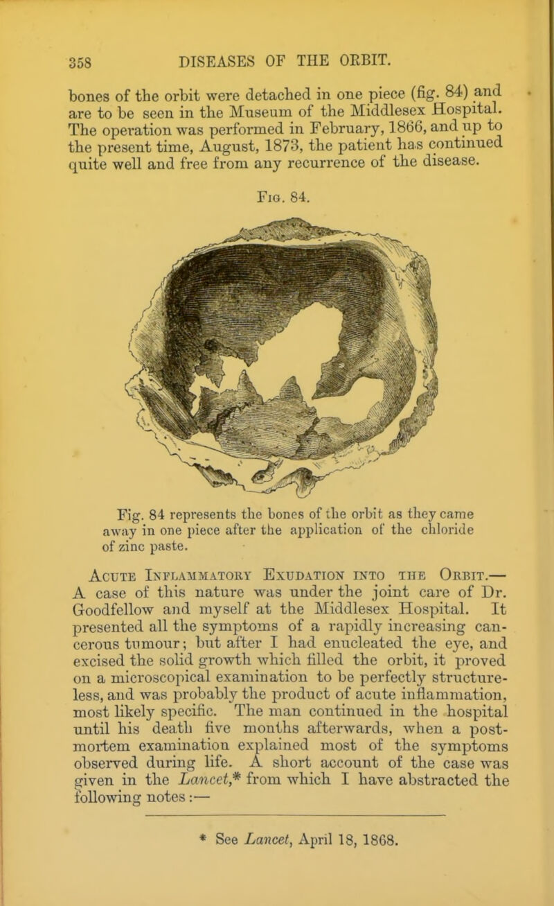 bones of the orbit were detached in one piece (fig. 84) and are to be seen in the Museum of the Middlesex Hospital, The operation was performed in February, 1866, and up to the present time, August, 1873, the patient ha s continued quite well and free from any recurrence of the disease. Fig. 84. Fig. 84 represents the bones of the orbit as they came away in one piece after the application of the chloride of zinc paste. Acute Inflammatory Exudation into the Orbit.— A case of this nature was under the joint care of Dr. Goodfellow and myself at the Middlesex Hospital. It presented all the symptoms of a rapidly increasing can- cerous tumour; but after I had enucleated the eye, and excised the solid growth which tilled the orbit, it proved on a microscopical examination to be perfectly structure- less, and was probably the product of acute iuflanunation, most likely specific. The man continued in the hospital until his death five months afterwards, when a post- mortem examination explained most of the symptoms observed during life. A short account of the case was given in the Lancet,* from which I have abstracted the following notes:— * See Lancet, April 18, 1868.