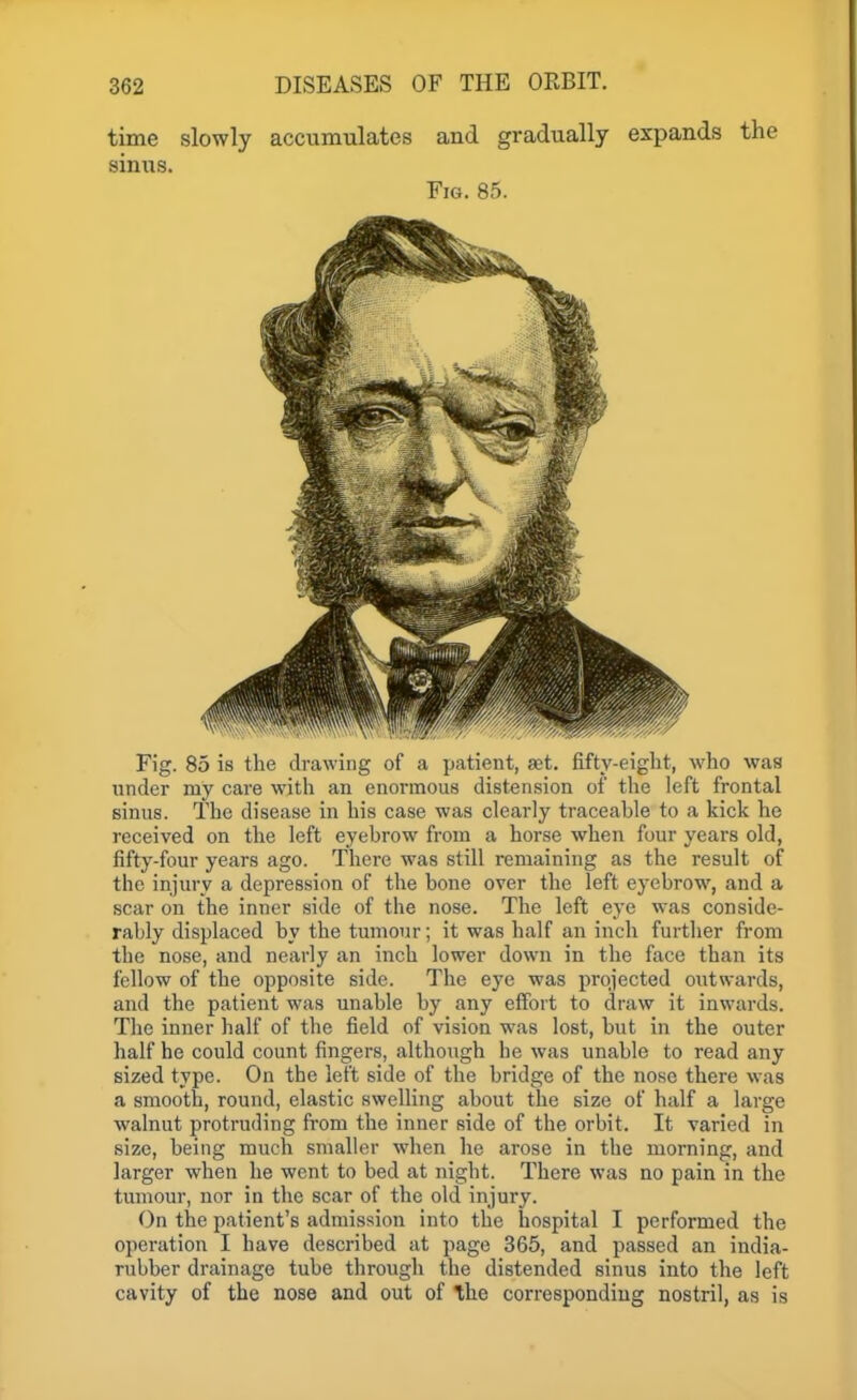 time slowly accumulates and gradually expands the siniis. Fig. 85. Fig. 85 is the drawing of a patient, set. fifty-eight, who waa under my care with an enormous distension of the left frontal sinus. The disease in his case was clearly traceable to a kick he received on the left eyebrow from a horse when four years old, fifty-four years ago. There was still remaining as the result of the injury a depression of the bone over the left eyebrow, and a scar on the inner side of the nose. The left eye was conside- rably displaced by the tumour; it was half an inch further from the nose, and nearly an inch lower down in the face than its fellow of the opposite side. The eye was projected outwards, and the patient was unable by any effort to draw it inwards. Tlie inner half of the field of vision was lost, but in the outer half he could count fingers, although he was unable to read any sized type. On the left side of the bridge of the nose there was a smooth, round, elastic swelling about the size of half a large walnut protruding from the inner side of the orbit. It varied in size, being much smaller when he arose in the morning, and larger when he went to bed at night. There was no pain in the tumour, nor in the scar of the old injury. On the patient's admission into the hospital I performed the operation I have described at page 365, and passed an india- rubber drainage tube through the distended sinus into the left cavity of the nose and out of the corresponding nostril, as is