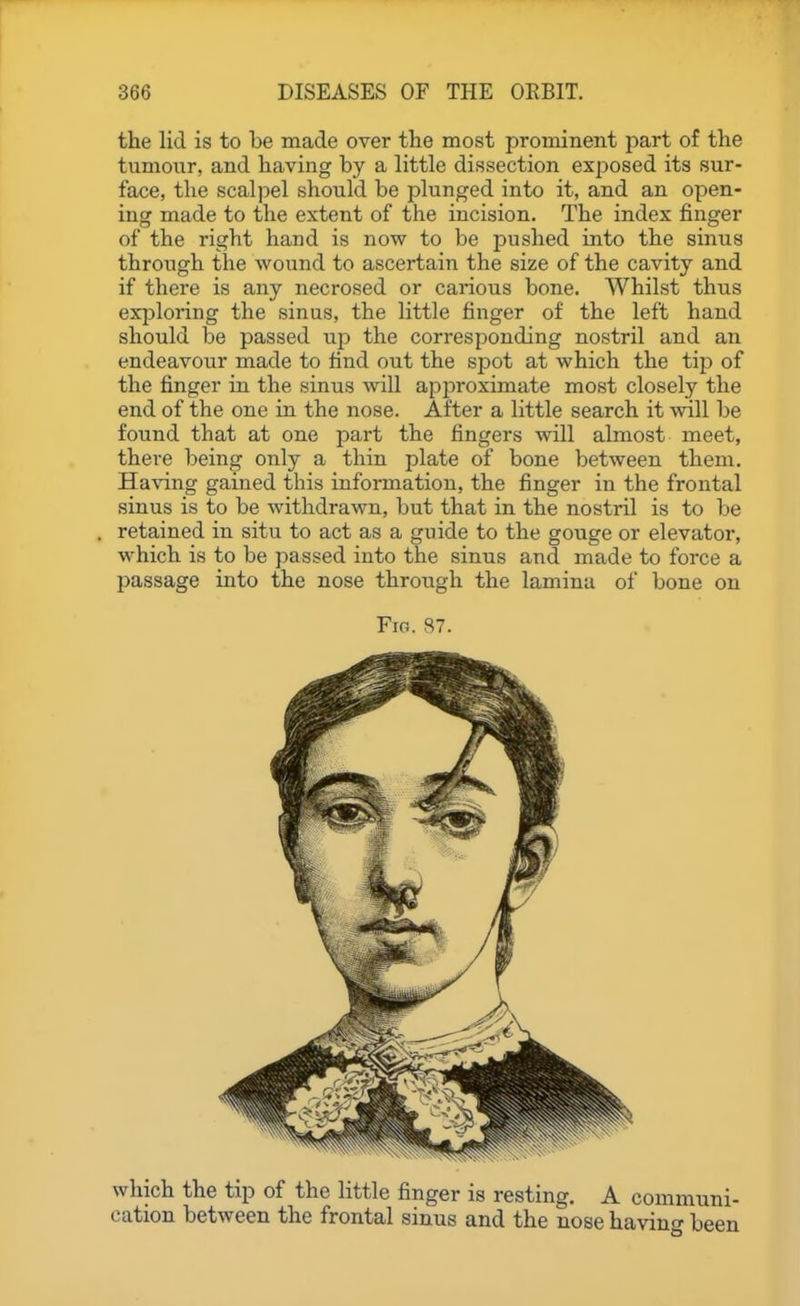 the lid is to be made over the most prominent part of the tumour, and having by a little dissection exjiosed its sur- face, the scalpel should be plunged into it, and an open- ing made to the extent of the incision. The index finger of the right hand is now to be pushed into the sinus through the wound to ascertain the size of the cavity and if there is any necrosed or carious bone. Whilst thus exploring the sinus, the little finger of the left hand should be passed ujd the corresponding nostril and an endeavour made to find out the spot at which the tip of the finger in the sinus will apjiroximate most closely the end of the one in the nose. After a little search it will be found that at one part the fingers will almost meet, there being only a thin plate of bone between them. Ha\'ing gained this information, the finger in the frontal sinus is to be withdrawn, but that in the nostril is to be retained in situ to act as a guide to the gouge or elevator, which is to be passed into the sinus and made to force a l^assage into the nose through the lamina of bone on Fio. 87. which the tip of the little finger is resting, A communi- cation between the frontal sinus and the nose having been