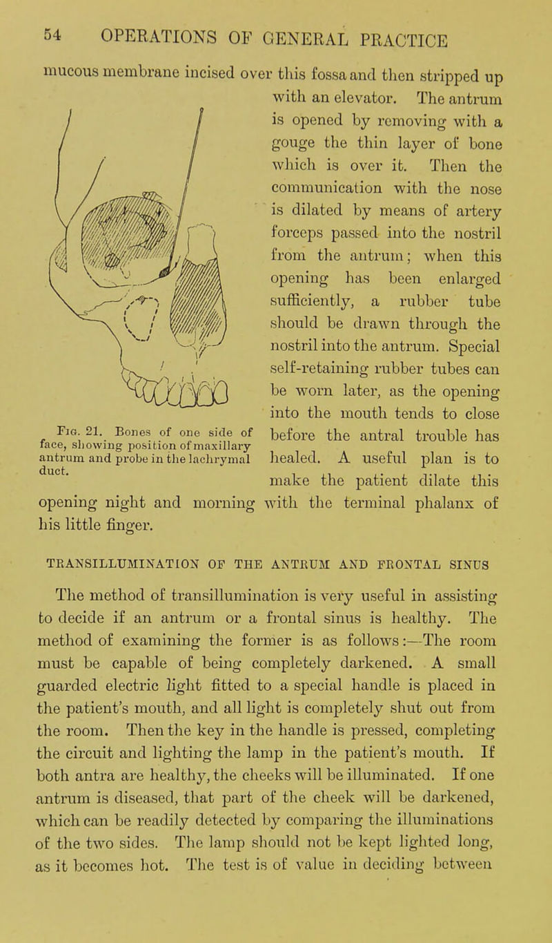 mucous membrane incised over this fossa and then stripped up with an elevator. The antrum is opened by removing with a gouge the thin layer of bone which is over it. Then the communication with the nose is dilated by means of artery forceps passed into the nostril from the antrum; when this opening has been enlarged sufficiently, a rubber tube should be drawn through the nostril into the antrum. Special self-retaining rubber tubes can be worn later, as the opening into the mouth tends to close Fig 21. Bodies of one side of before the antral trouble has race, sliowing position of maxillary antrum and probe in the lachrymal healed. A useful plan is to make the patient dilate this opening night and morning with the terminal phalanx of his little finger. TEANSILLUMINATION OF THE ANTRUM AND FKONTAL SINUS The method of transillumination is very useful in assisting to decide if an antrum or a frontal sinus is healthy. The method of examining the former is as follows:—The room must be capable of being completely darkened. A small guarded electric light fitted to a special handle is placed in the patient's mouth, and all light is completely shut out from the room. Then the key in the handle is pressed, completing the circuit and lighting the lamp in the patient's mouth. If both antra are healthy, the cheeks will be illuminated. If one antrum is diseased, that part of the cheek will be darkened, which can be readily detected by comparing the illuminations of the two sides. The lamp should not be kept lighted long, as it becomes hot. The test is of value in deciding between