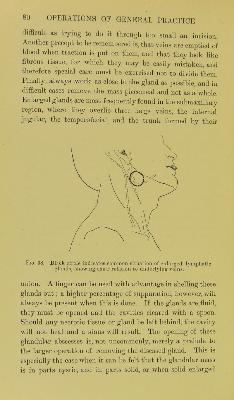 difficult as trying to do it throuo-li too small an incision. Another precept to be remembered is, that veins are emptied of blood when traction is put on them, and that they look like fibrous tissue, for which they may be easily mistaken, and therefore special care must be exercised not to divide them. Finally, always work as close to the gland as possible, and in difficult cases remove the mass piecemeal and not as a whole. Enlarged glands are most frequently found in the submaxillary region, where they overlie three large veins, the internal jugular, the temporofacial, and the trunk formed by their Fig. 38. Bl.nck oircle indicates common situation of enlarged lymphatic glands, sliowing their relation to underlying veins. union. A finger can be used with advantage in shelling these glands out; a higher percentage of suppuration, however,will always be present when this is done. If the glands are fluid, they must be opened and the cavities cleared with a spoon. Should any necrotic tissue or gland be left behind, the cavity will not heal and a sinus will result. The opening of these glandular abscesses is, not uncommonlj^ merely a prelude to the larger operation of removing the diseased gland. This is especially the case when it can be felt that the glandular mass is in parts cystic, and in parts solid, or when solid enlarged