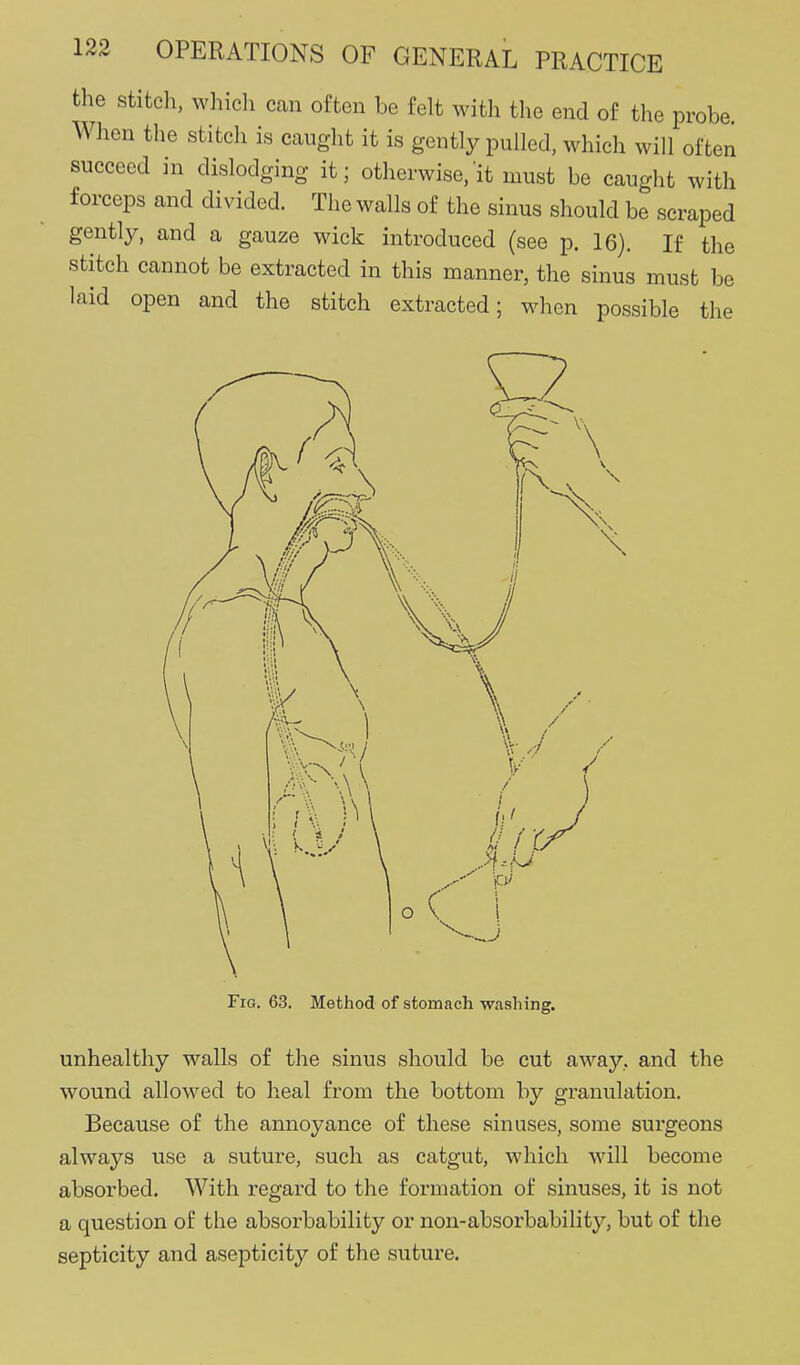 the stitch, which can often be felt with the end of the probe. When the stitch is caught it is gently pulled, which will often succeed in dislodging it; otherwise, it must be caught with forceps and divided. The walls of the sinus should be scraped gently, and a gauze wick introduced (see p. 16). If the stitch cannot be extracted in this manner, the sinus must be laid open and the stitch extracted; when possible the Fig. 63. Method of stomach washing. unhealthy walls of the sinus should be cut away, and the wound allowed to heal from the bottom by granulation. Because of the annoyance of these sinuses, some surgeons always use a suture, such as catgut, which will become absorbed. With regard to the formation of sinuses, it is not a question of the absorbability or non-absorbability, but of the septicity and asepticity of the suture.