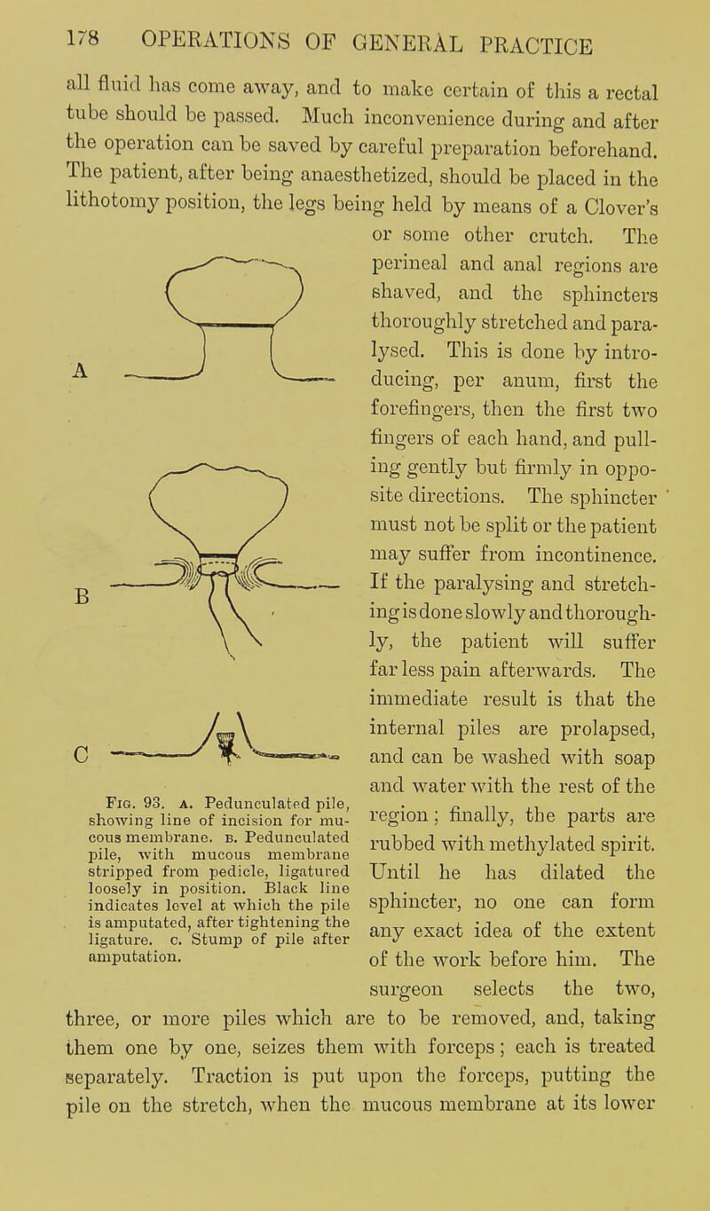 all fluid has come away, and to make certain of this a rectal tube should be passed. Much inconvenience during and after the operation can be saved by careful preparation beforehand. The patient, after being anaesthetized, should be placed in the lithotomy position, the legs being held by means of a Clover's or some other crutch. The perineal and anal regions are shaved, and the sphincters thoroughly stretched and para- lysed. This is done by intro- ducing, per anum, first the forefingers, then the first two fingers of each hand, and pull- ing gently but firmly in oppo- site directions. The sphincter must not be split or the patient may suffer from incontinence. If the paralysing and stretch- ing is done slowly and thorough- ly, the patient will suffer far less pain afterwards. The immediate result is that the internal piles are prolapsed, and can be washed with soap and water with the rest of the region ; finally, the parts are rubbed with methylated spirit. Until he has dilated the sphincter, no one can form any exact idea of the extent of the work before him. The surgeon selects the two, three, or more piles which are to be removed, and, taking them one by one, seizes them with forceps; each is treated separately. Traction is put upon the forceps, putting the pile on the stretch, when the mucous membrane at its lower B C Fig. 93. a. Pedunculated pile, showing line of incision for mu- cous membrane, b. Pedunculated pile, with mucous membrane stripped from pedicle, ligatured loosely in position. Black line indicates level at which the pile is amputated, after tightening the ligature, c. Stump of pile after amputation.