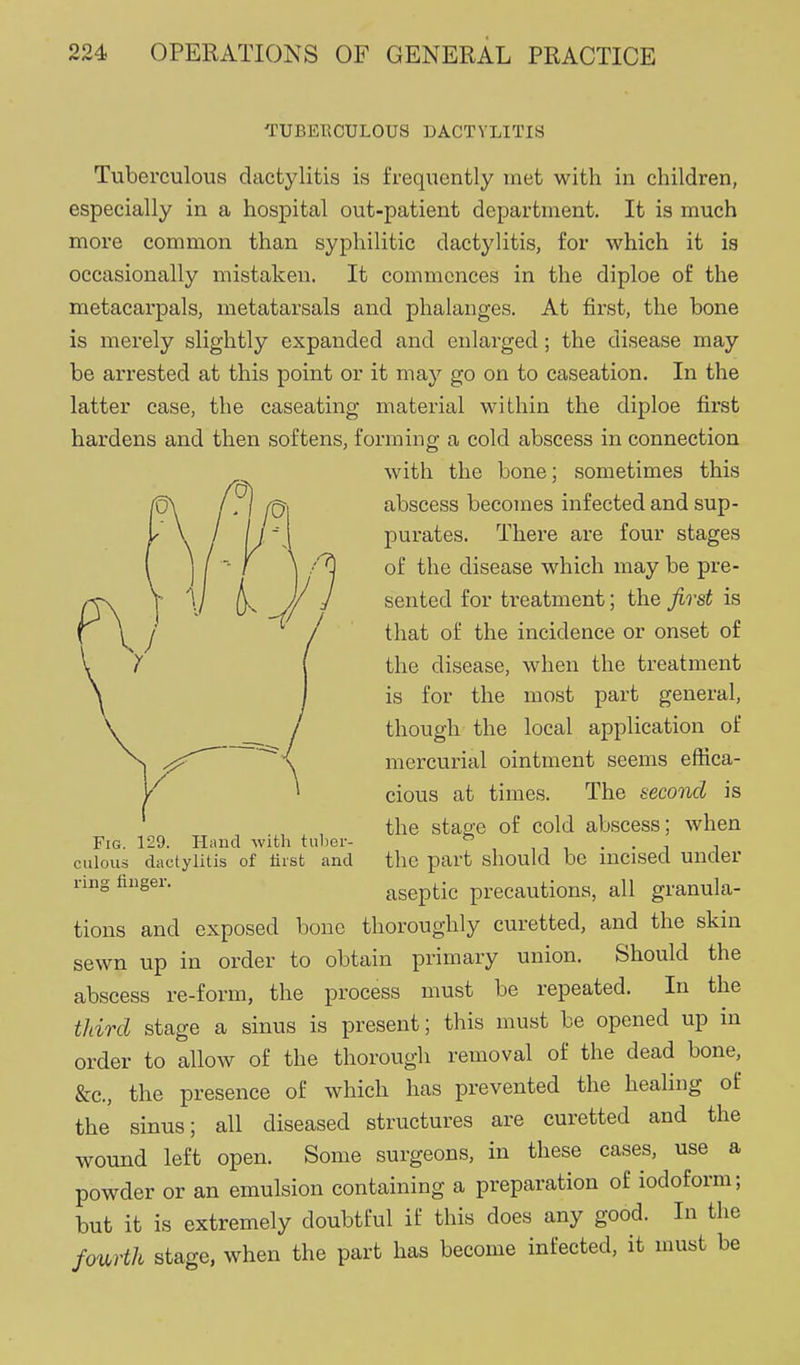 TUBERCULOUS DACTYLITIS Tuberculous dactylitis is frequently met with in children, especially in a hospital out-patient department. It is much more common than syphilitic dactylitis, for which it is occasionally mistaken. It commences in the diploe of the metacarpals, metatarsals and phalanges. At first, the bone is merely slightly expanded and enlarged; the disease may be arrested at this point or it may go on to caseation. In the latter case, the caseating material within the diploe first hardens and then softens, forming a cold abscess in connection with the bone; sometimes this abscess becomes infected and sup- purates. There are four stages of the disease which may be pre- (y\ \ ^ ^ sented for treatment; the first is \ \ / / that of the incidence or onset of the disease, when the treatment is for the most part general, though the local application of mercurial ointment seems effica- cious at times. The second is the stage of cold abscess; when the part should be incised under aseptic precautions, all granula- tions and exposed bone thoroughly curetted, and the skin sewn up in order to obtain primary union. Should the abscess re-form, the process must be repeated. In the third stage a sinus is present; this must be opened up in order to allow of the thorough removal of the dead bone, &c., the presence of which has prevented the healing of the sinus; all diseased structures are curetted and the wound left open. Some surgeons, in these cases, use a powder or an emulsion containing a preparation of iodoform; but it is extremely doubtful if this does any good. In the fourth stage, when the part has become infected, it must be Fig. 129. Hand with tulier- ciilous dactylitis of liist and ring finger.