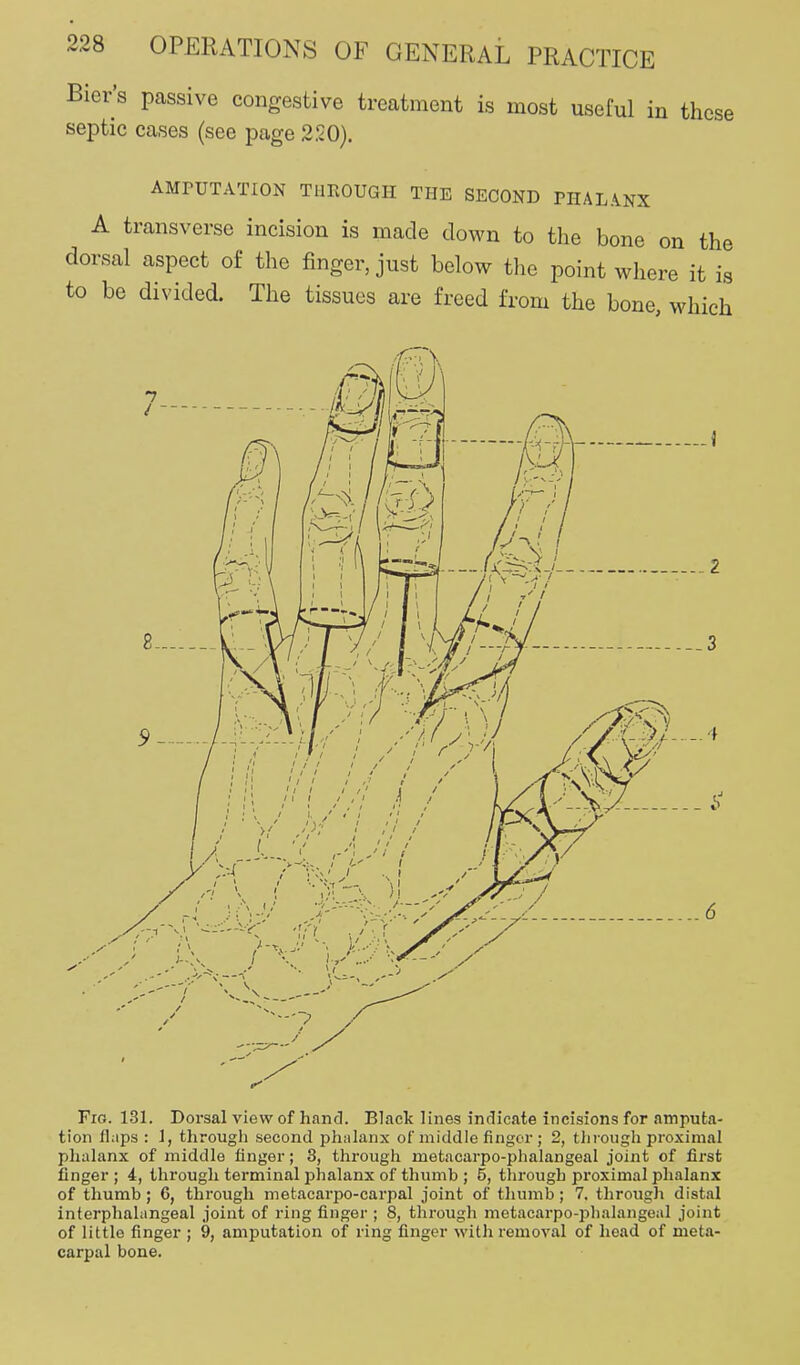 Bier's passive congestive treatment is most useful in these septic cases (see page 2SO). AMrUTATION THROUGH THE SECOND PHAL.VNX A transverse incision is made down to the bone on the dorsal aspect of the finger, just below the point where it is to be divided. The tissues are freed from the bone, which •7 / - IT-/if : /M- ..6 Fig. 131. Dorsal view of hand. Black lines indicate incisions for amputa- tion fl;ips : 1, through second phalanx of middle finger ; 2, through proximal phalanx of middle finger; 3, through metacarpo-phalangeal joint of first finger; i, through terminal phalanx of thumb ; 5, through proximal phalanx of thumb; 6, through metacarpo-carpal joint of thumb; 7. through distal interphaliingeal joint of ring finger ; 8, through metacarpo-plialangeal joint of little finger ; 9, amputation of ring finger with removal of head of meta- carpal bone.