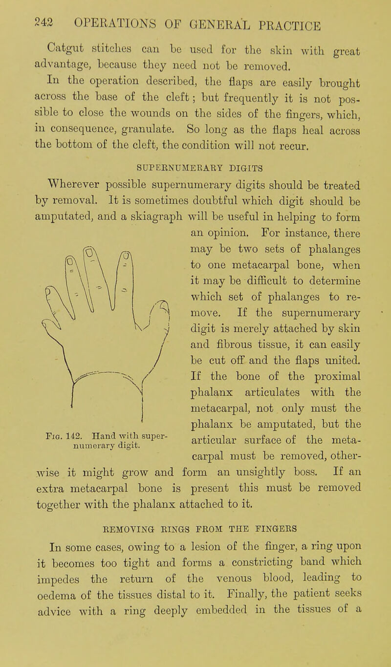 Catgut stitches can be used for the skin with great advantage, because they need not be removed. In the operation described, the flaps are easily brought across the base of the cleft; but frequently it is not pos- sible to close the wounds on the sides of the fingers, which, in consequence, granulate. So long as the flaps heal across the bottom of the cleft, the condition will not recur. SUPEENDMERARY DIGITS Wherever possible supernumerary digits should be treated by removal. It is sometimes doubtful which digit should be amputated, and a skiagraph will be useful in helping to form an opinion. For instance, there may be two sets of phalanges to one metacarpal bone^ when it may be difiicult to determine which set of phalanges to re- move. If the supernumerary digit is merely attached by skin and fibrous tissue, it can easily be cut off and the flaps united. If the bone of the proximal phalanx articulates with the metacarpal, not only must the phalanx be amputated, but the articular surface of the meta- carpal must be removed, other- wise it might grow and form an unsightly boss. If an extra metacarpal bone is present this must be removed together with the phalanx attached to it. REMOVINa RINGS FROM THE FINGERS In some cases, owing to a lesion of the finger, a ring upon it becomes too tight and forms a constricting band which impedes the return of the venous blood, leading to oedema of the tissues distal to it. Finally, the patient seeks advice with a ring deeply embedded in the tissues of a Fig. 142. Hand with super- numerary digit.