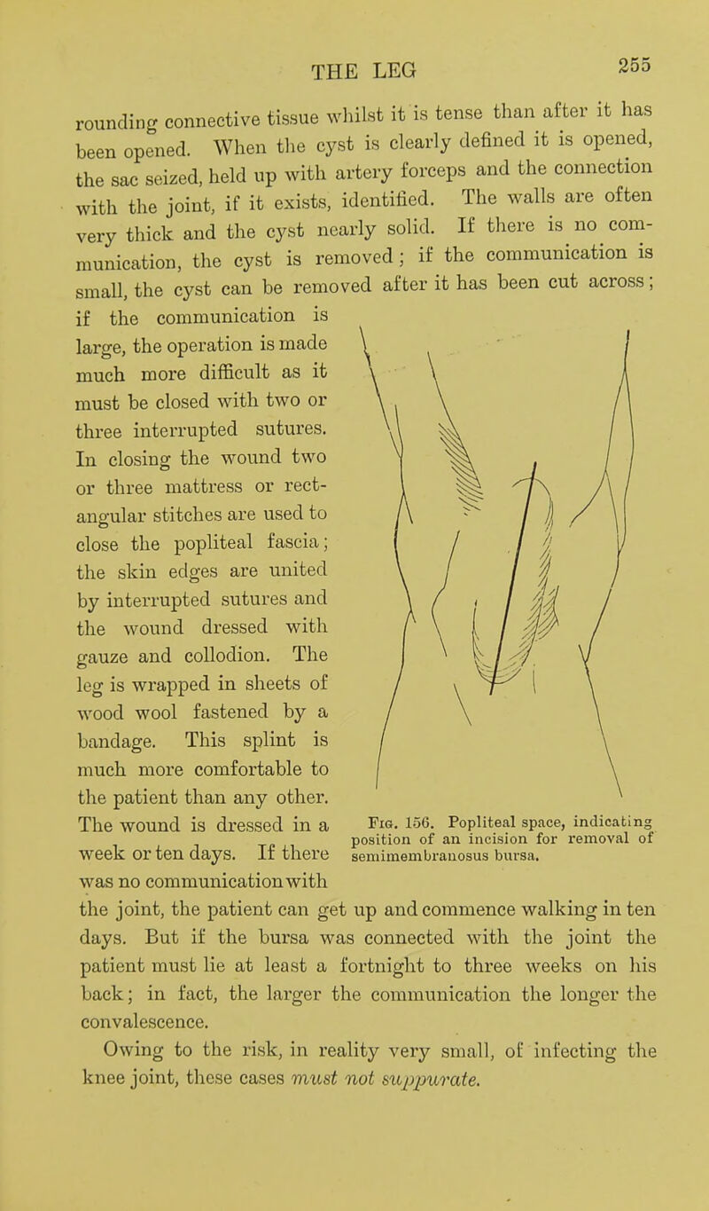 rounding connective tissue wliilst it is tense than after it has been opened. When the cyst is clearly defined it is opened, the sac seized, held up with artery forceps and the connection with the joint, if it exists, identified. The walls are often very thick and the cyst nearly solid. If there is no com- munication, the cyst is removed; if the communication is small, the cyst can be removed after it has been cut across; if the communication is large, the operation is made much more difficult as it must be closed with two or three interrupted sutures. In closing the wound two or three mattress or rect- angular stitches are used to close the popliteal fascia; the skin edges are united by interrupted sutures and the wound dressed with gauze and collodion. The leg is wrapped in sheets of wood wool fastened by a bandage. This splint is much more comfortable to the patient than any other. The wound is dressed in a week or ten days. If there was no communication with the joint, the patient can get up and commence walking in ten days. But if the bursa was connected with the joint the patient must lie at least a fortnight to three weeks on his back; in fact, the larger the communication the longer the convalescence. Owing to the risk, in reality very small, of infecting the knee joint, these cases must not suppurate. Fig. 1.56. Popliteal space, indicating position of an incision for removal of semimembranosus bui'sa.