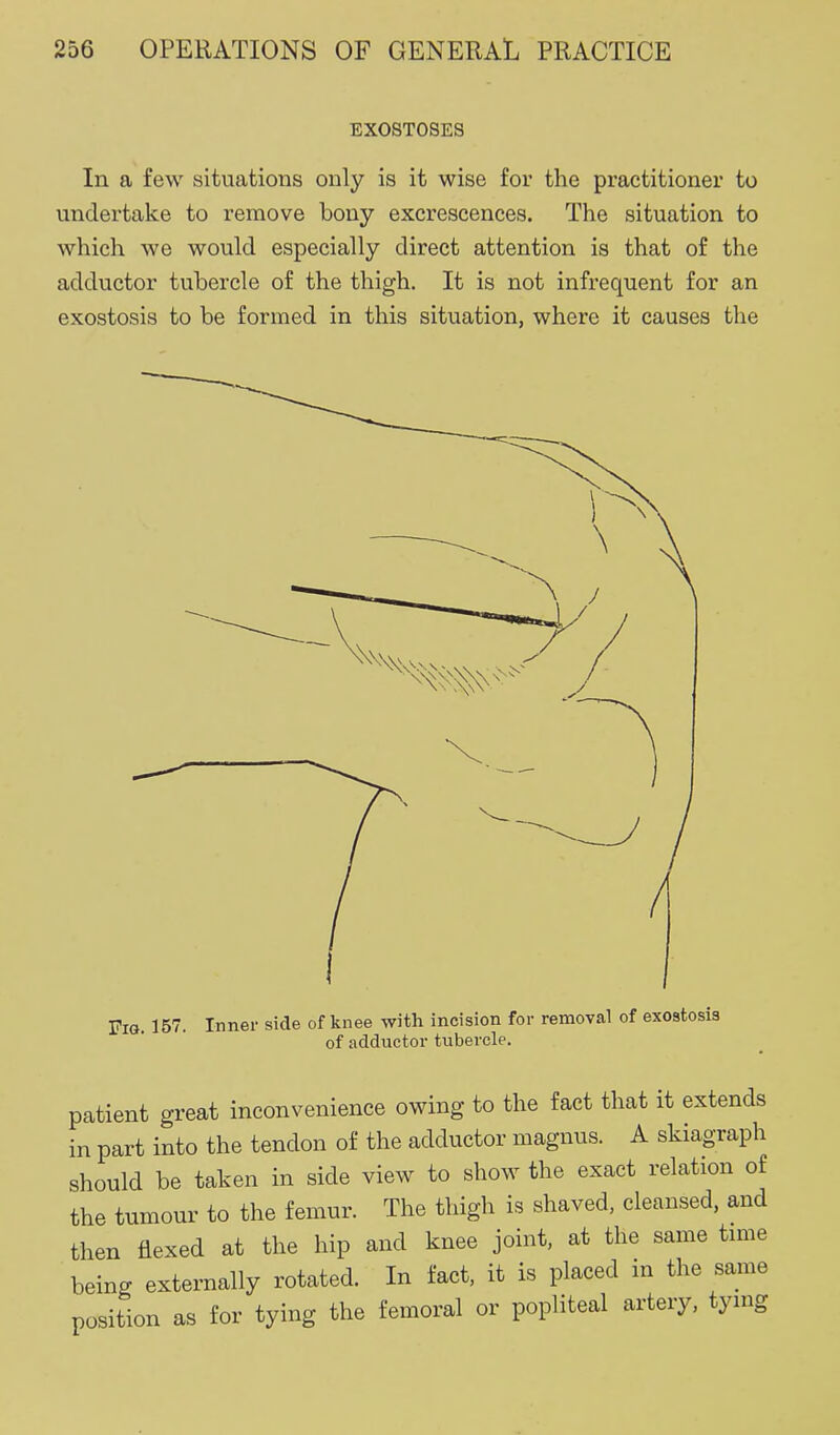 EXOSTOSES In a few situations only is it wise for the practitioner to undertake to remove bony excrescences. The situation to which we would especially direct attention is that of the adductor tubercle of the thigh. It is not infrequent for an exostosis to be formed in this situation, where it causes the Fra 157. Inner side of knee with incision for removal of exostosis of adductor tubercle. patient great inconvenience owing to the fact that it extends in part into the tendon of the adductor magnus. A skiagraph should be taken in side view to show the exact relation of the tumour to the femur. The thigh is shaved, cleansed, and then flexed at the hip and knee joint, at the same tmie being externally rotated. In fact, it is placed in the same position as for tying the femoral or popliteal artery, tymg