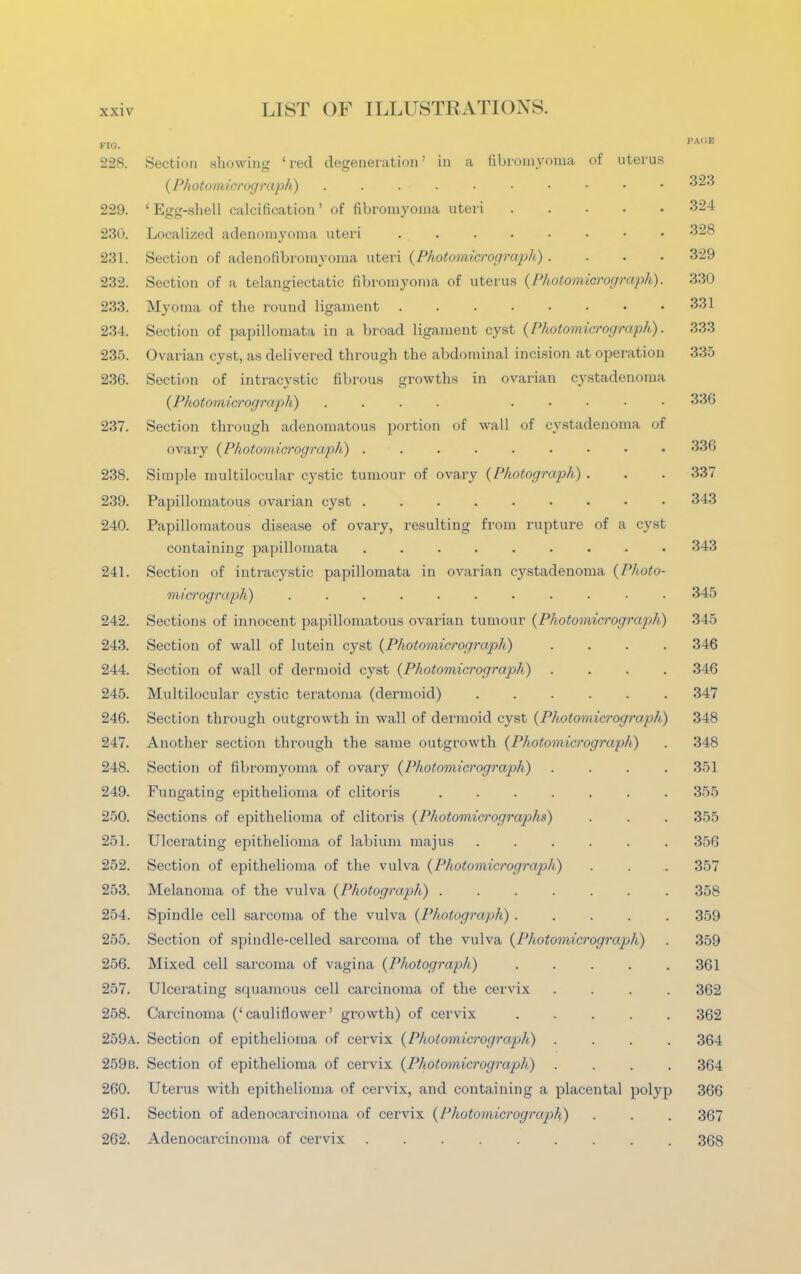 FIO. 228. Section showing 'red degeneration' in a fibromyoma of uterus {Photomicrograph) 229. 1 Egg-shell calcification ' of fibromyoma uteri .... 230. Localized adenomyoma uteri ....... 231. Section of adenofibromyoina uteri {Photomicrograph) . 232. Section of a telangiectatic fibromyoma of uterus {Photomicrograph) 233. Myoma of the round ligament 234. Section of papillomata in a broad ligament cyst {Photomicrograph) 235. Ovarian cyst, as delivered through the abdominal incision at operation 236. Section of intracystic fibrous growths in ovarian cystadenoma {Photomicrograph) .... .... 237. Section through adenomatous portion of wall of cystadenoma o ovary {Photomicrograph) ........ 238. Simple multilocular cystic tumour of ovary {Photograph) . 239. Papillomatous ovarian cyst 240. Papillomatous disease of ovary, resulting from rupture of a cyst containing papillomata ........ 241. Section of intracystic papillomata in ovarian cystadenoma {Photo mici'ograph) 242. Sections of innocent papillomatous ovarian tumour {Photomicrograph) 243. Section of wall of lutein cyst {Photomicrograph) 244. Section of wall of dermoid cyst {Photomicrograph) 245. Multilocular cystic teratoma (dermoid) 246. Section through outgrowth in wall of dermoid cyst {Photomicrograph) 247. Another section through the same outgrowth {Photomicrograph) 248. Section of fibromyoma of ovary {Photomicrograph) 249. Fungating epithelioma of clitoris ...... 250. Sections of epithelioma of clitoris {Photomicrographs) 251. Ulcerating epithelioma of labium majus ..... 252. Section of epithelioma of the vulva {Photomicrograph) 253. Melanoma of the vulva {Photograph) ...... 254. Spindle cell sarcoma of the vulva {Photograph) .... 255. Section of spindle-celled sarcoma of the vulva {Photomicrograph) 256. Mixed cell sarcoma of vagina {Photograph) 257. Ulcerating squamous cell carcinoma of the cervix 258. Carcinoma ('cauliflower' growth) of cervix 259a. Section of epithelioma of cervix {Photomicrograph) 259b. Section of epithelioma of cervix {Photomicrograph) 260. Uterus with epithelioma of cervix, and containing a placental polyp 261. Section of adenocarcinoma of cervix {Photomicrograph) 262. Adenocarcinoma of cervix i>ai;E 323 324 328 329 330 331 333 335