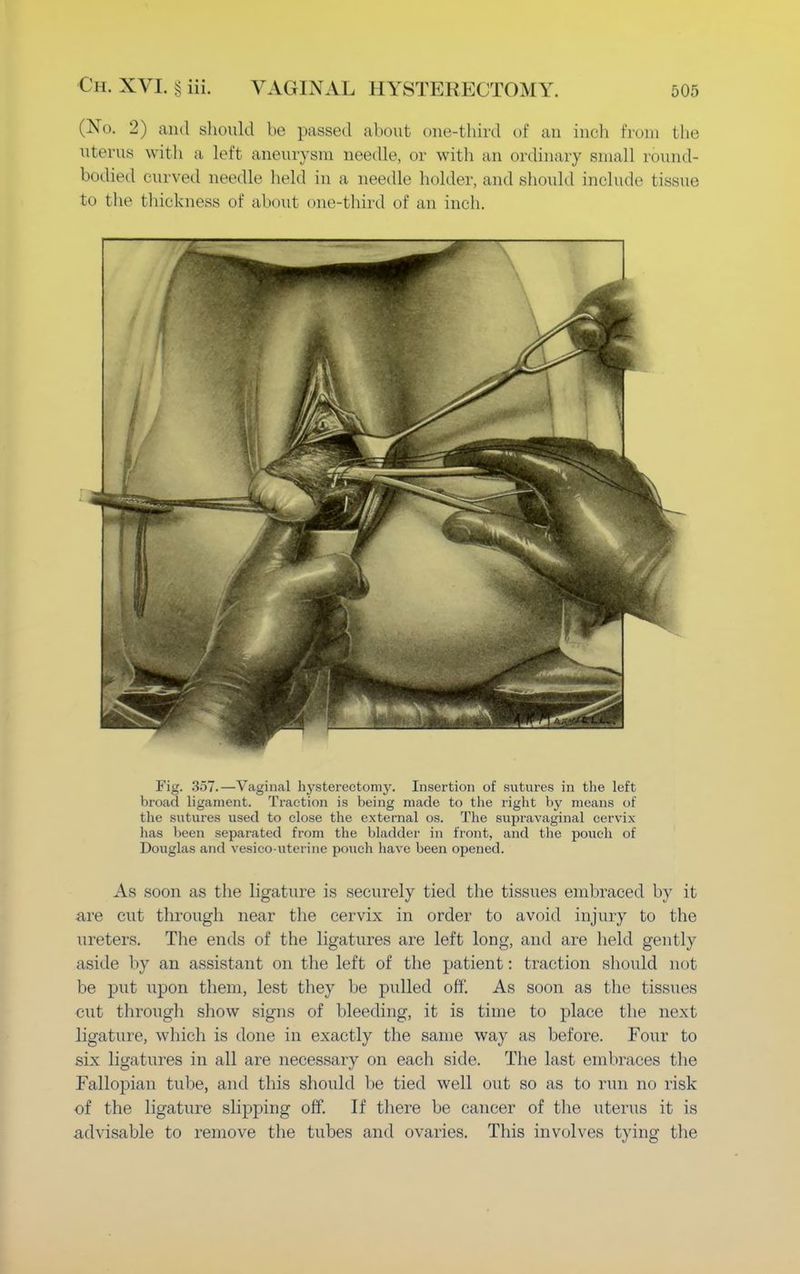 (No. 2) and should be passed about one-third of an inch from the uterus with a left aneurysm needle, or with an ordinary small round- bodied curved needle held in a needle holder, and should include tissue bo the thickness of about one-third of an inch. Fig. 357.—Vaginal hysterectomy. Insertion of sutures in the left broad ligament. Traction is being made to the right by means of the sutures used to close the external os. The supravaginal cervix lias been separated from the bladder in front, and the pouch of Douglas and vesico-uterine pouch have been opened. As soon as the ligature is securely tied the tissues embraced by it are cut through near the cervix in order to avoid injury to the ureters. The ends of the ligatures are left long, and are held gently aside by an assistant on the left of the patient: traction should not be put upon them, lest they be pulled off. As soon as the tissues cut through show signs of bleeding, it is time to place the next ligature, which is done in exactly the same way as before. Four to six ligatures in all are necessary on each side. The last embraces the Fallopian tube, and this should be tied well out so as to run no risk of the ligature slipping off. If there be cancer of the uterus it is advisable to remove the tubes and ovaries. This involves tying the