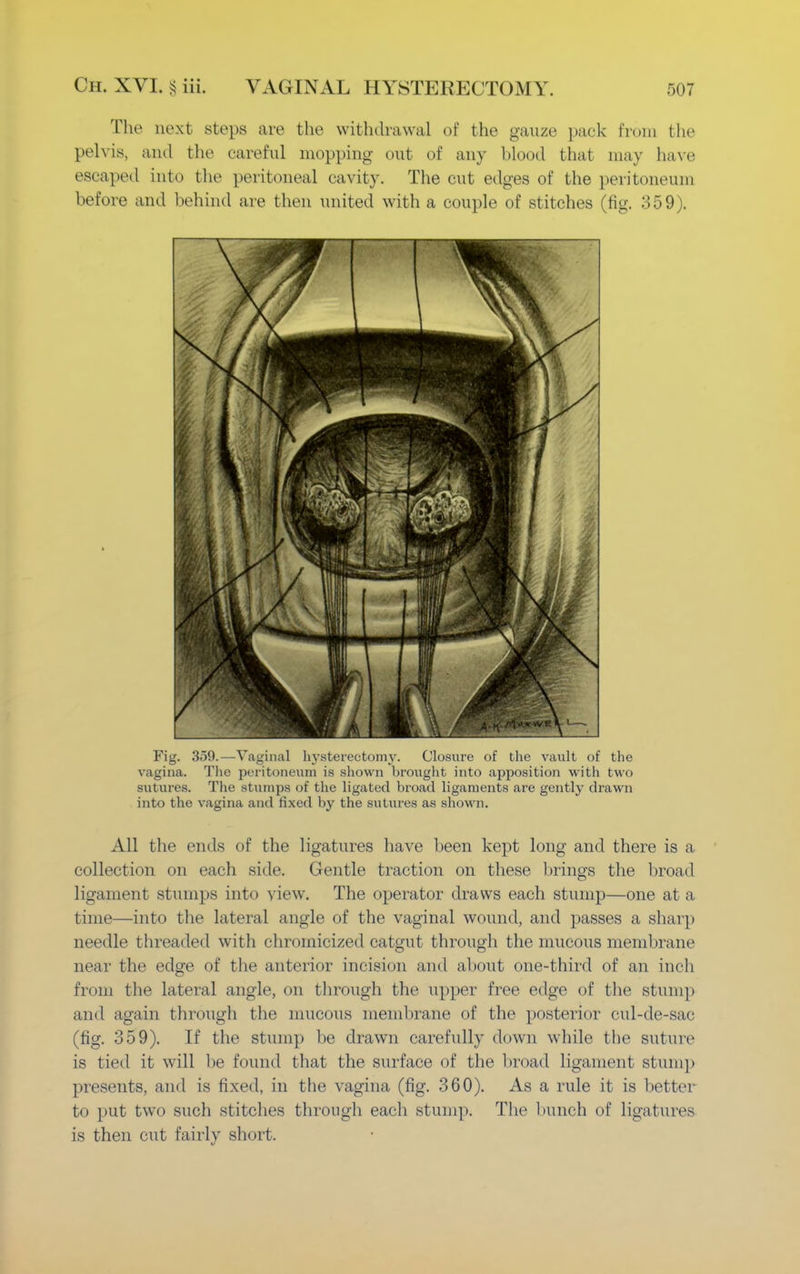 The next steps are the withdrawal of the gauze pack from the pelvis, ami the careful mopping out of any blood that may have escaped into the peritoneal cavity. The cut edges of the peritoneum before and behind are then united with a couple of stitches (fig. 359). Fig. 359.—Vaginal hysterectomy. Closure of the vault of the vagina. The peritoneum is shown brought into apposition with two sutures. The stumps of the ligated broad ligaments are gently drawn into the vagina and fixed by the sutures as shown. All the ends of the ligatures have been kept long and there is a collection on each side. Gentle traction on these brings the broad ligament stumps into view. The operator draws each stump—one at a time—into the lateral angle of the vaginal wound, and passes a sharp needle threaded with chromicized catgut through the mucous membrane near the edge of the anterior incision and about one-third of an inch from the lateral angle, on through the upper free edge of the stump and again through the mucous membrane of the posterior cul-de-sac (fig. 359). If the stump be drawn carefully down while the suture is tied it wrill lie found that the surface of the broad ligament stump presents, and is fixed, in the vagina (fig. 360). As a rule it is better to put two such stitches through eacli stump. The bunch of ligatures is then cut fairly short.