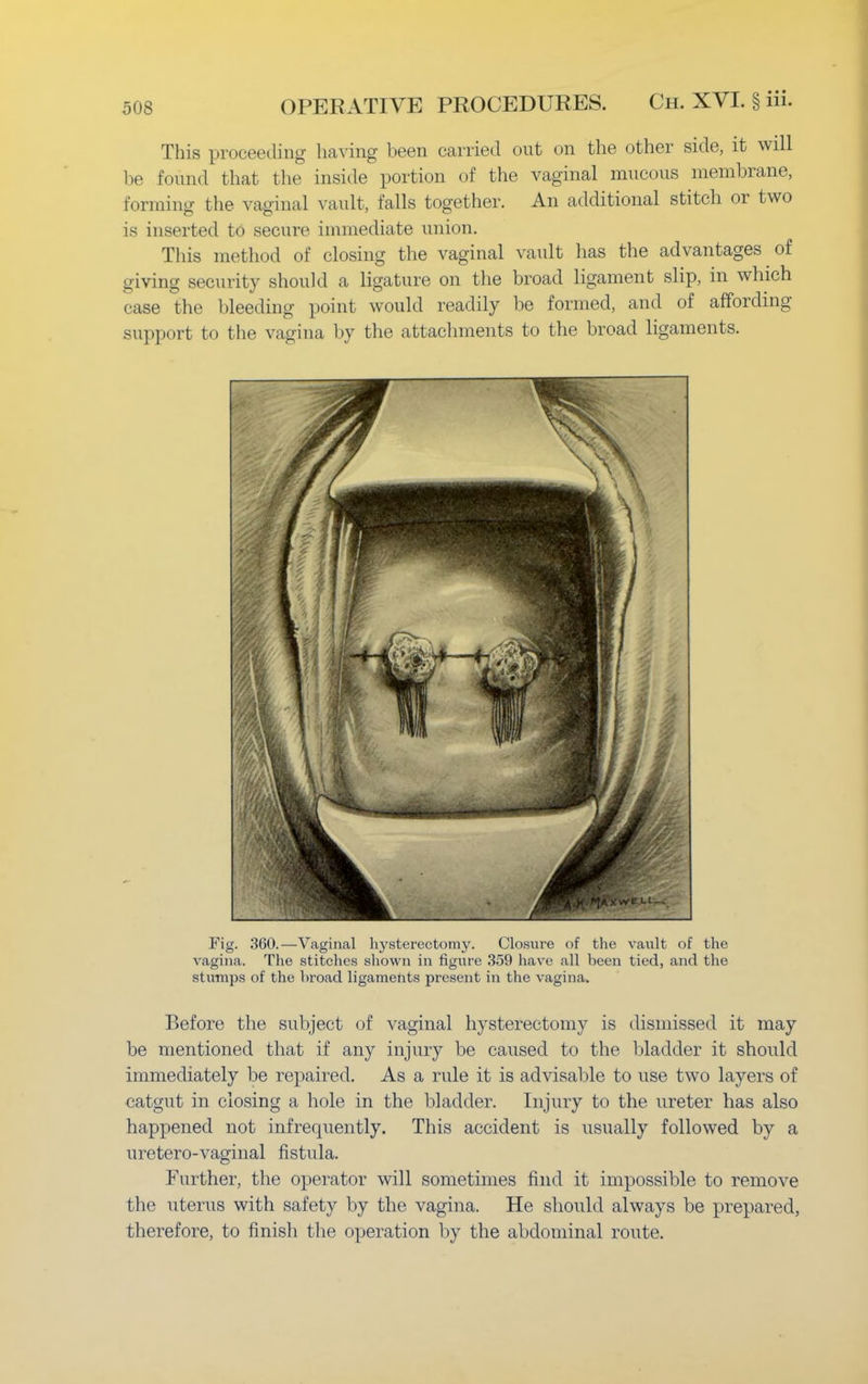 This proceeding having been carried out on the other side, it will be found that the inside portion of the vaginal mucous membrane, forming the vaginal vault, falls together. An additional stitch or two is inserted to secure immediate union. This method of closing the vaginal vault lias the advantages of giving security should a ligature on the broad ligament slip, in which case the bleeding point would readily be formed, and of affording support to the vagina by the attachments to the broad ligaments. Fig. 360.—Vaginal hysterectomy. Closure of the vault of the vagina. The stitches shown in figure 359 have all been tied, and the stumps of the broad ligaments present in the vagina. Before the subject of vaginal hysterectomy is dismissed it may be mentioned that if any injury be caused to the bladder it should immediately be repaired. As a rule it is advisable to use two layers of catgut in closing a hole in the bladder. Injury to the ureter has also happened not infrequently. This accident is usually followed by a uretero-vaginal fistula. Further, the operator will sometimes find it impossible to remove the uterus with safety by the vagina. He should always be prepared, therefore, to finish the operation by the abdominal route.