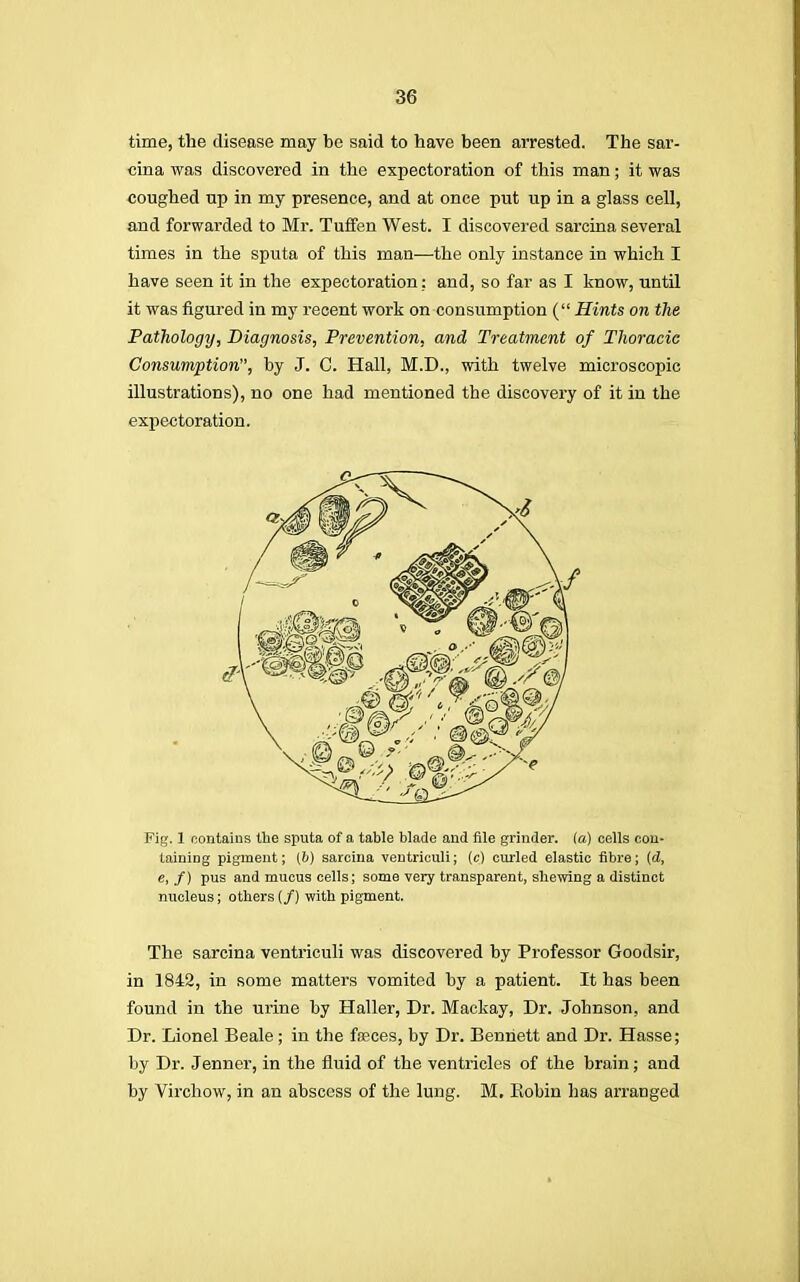 time, the disease may be said to have been arrested. The sar- cina was discovered in the expectoration of this man; it was coughed up in my presence, and at once put up in a glass cell, and forwarded to Mr. Tuffen West. I discovered sarcina several times in the sputa of this man—the only instance in which I have seen it in the expectoration: and, so far as I know, until it was figured in my recent work on consumption ( Hints on the Pathology, Diagnosis, Prevention, and Treatment of Thoracic Consumption, by J. C. Hall, M.D., with twelve microscopic illustrations), no one had mentioned the discovery of it in the expectoration. Fig. 1 contains the sputa of a table blade and file grinder, ia) cells con- taining pigment; [b) sarcina ventriculi; (c) curled elastic fibre; {d, e, f) pus and mucus cells; some very transparent, shewing a distinct nucleus; others (/) with pigment. The sarcina ventriculi was discovered by Professor Goodsir, in 1842, in some matters vomited by a patient. It has been found in the urine by Haller, Dr. Mackay, Dr. Johnson, and Dr. Lionel Beale; in the faeces, by Dr. Bennett and Dr. Hasse; by Dr. Jenner, in the fluid of the ventricles of the brain; and by Virchow, in an abscess of the lung. M, Kobin has arranged
