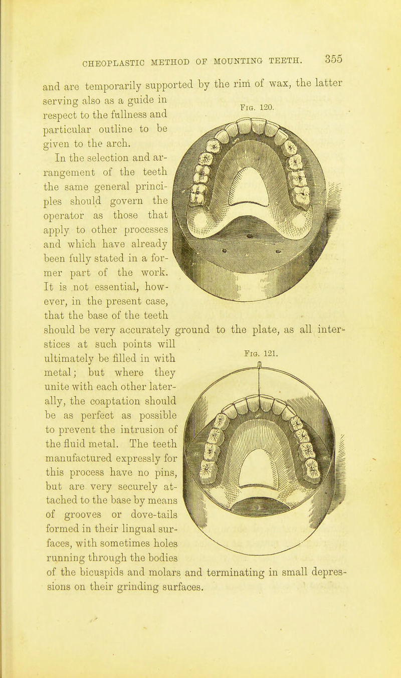 YiG. 120. and are temporarily supported by the rim of wax, the latter serving also as a guide in respect to the fullness and particular outline to be sciven to the arch. In the selection and ar- rangement of the teeth the same general princi- ples should govern the operator as those that apply to other processes and which have already been fully stated in a for- mer part of the work. It is not essential, how- ever, in the present case, that the base of the teeth should be very accurately ground to the plate, as all inter- stices at such points will ultimately be filled in with metal; but where they unite with each other later- ally, the coaptation should be as perfect as possible to prevent the intrusion of the fluid metal. The teeth manufactured expressly for this process have no pins, but are very securely at- tached to the base by means of grooves or dove-tails formed in their lingual sur- faces, with sometimes holes running through the bodies of the bicuspids and molars and terminating in small depres- sions on their grinding surfaces.