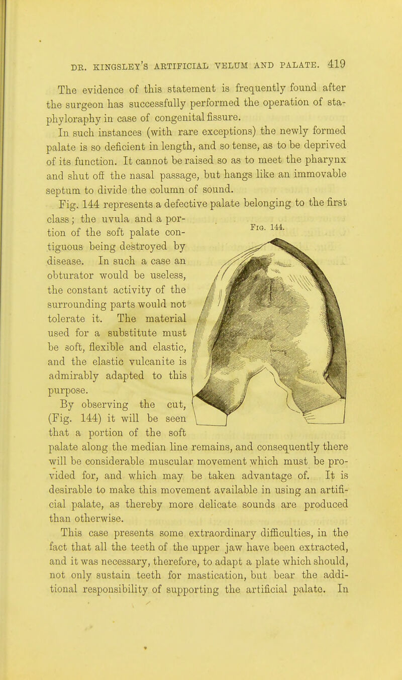 The evidence of this statement is frequently found after the surgeon has successfully performed the operation of sta- phyloraphy in case of congenital fissure. In such instances (with rare exceptions) the newly formed palate is so deficient in length, and so tense, as to be deprived of its function. It cannot be raised so as to meet the pharynx and shut off the nasal passage, but hangs like an immovable septum to divide the column of sound. Fig. 144 represents a defective palate belonging to the first class; the uvula and a por- tion of the soft palate con- tiguous being destroyed by disease. In such a case an obturator would be useless, the constant activity of the surrounding parts would not tolerate it. The material used for a substitute must be soft, flexible and elastic, and the elastic vulcanite is admirably adapted to this purpose. By observing the cut, (Fig. 144) it will be seen that a portion of the soft palate along the median line remains, and consequently there will be considerable muscular movement which must be pro- vided for, and which may be taken advantage of. It is desirable to make this movement available in using an artifi- cial palate, as thereby more delicate sounds are produced than otherwise. This case presents some extraordinary difficulties, in the fact that all the teeth of the upper jaw have been extracted, and it was necessary, therefore, to adapt a plate which should, not only sustain teeth for mastication, but bear the addi- tional responsibility of supporting the artificial palate. In