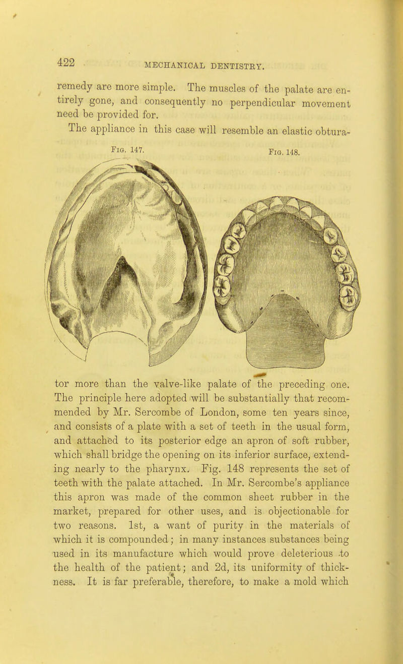 remedy are more simple. The muscles of the palate are en- tirely gone, and consequently no perpendicular movement need be provided for. The appliance in this case will resemble an elastic obtura- FiG. 147. Fig. 148. tor more than the valve-like palate of the preceding one. The principle here adopted will be substantially that recom- mended by Mr. Sercombe of London, some ten years since, and consists of a plate with a set of teeth in the usual form, and attached to its posterior edge an apron of soft rubber, which shall bridge the opening on its inferior surface, extend- ing nearly to the pharynx. Fig. 148 represents the set of teeth with the palate attached. In Mr. Sercombe's appliance this apron was made of the common sheet rubber in the market, prepared for other uses, and is objectionable for two reasons. 1st, a want of purity in the materials of which it is compounded; in many instances substances being used in its manufacture which would prove deleterious .to the health of the patient; and 2d, its uniformity of thick- ness. It is far preferab'le, therefore, to make a mold which