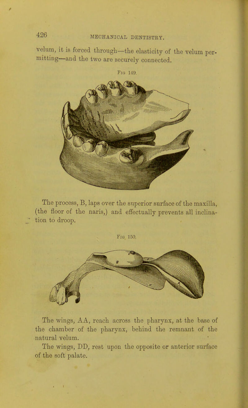 velum, it is forced through—the elasticity of the velum per- mitting—and the two are securely connected. Fio 149. The process, B, laps over the superior surface of the maxilla, (the floor of the naris,) and effectually prevents all inclina- tion to droop. Fig 150. The wings, AA, reach across the pharynx, at the base of the chamber of the pharynx, behind the remnant of the natural velum. The wings, DD, rest upon the opposite or anterior surface of the soft palate.