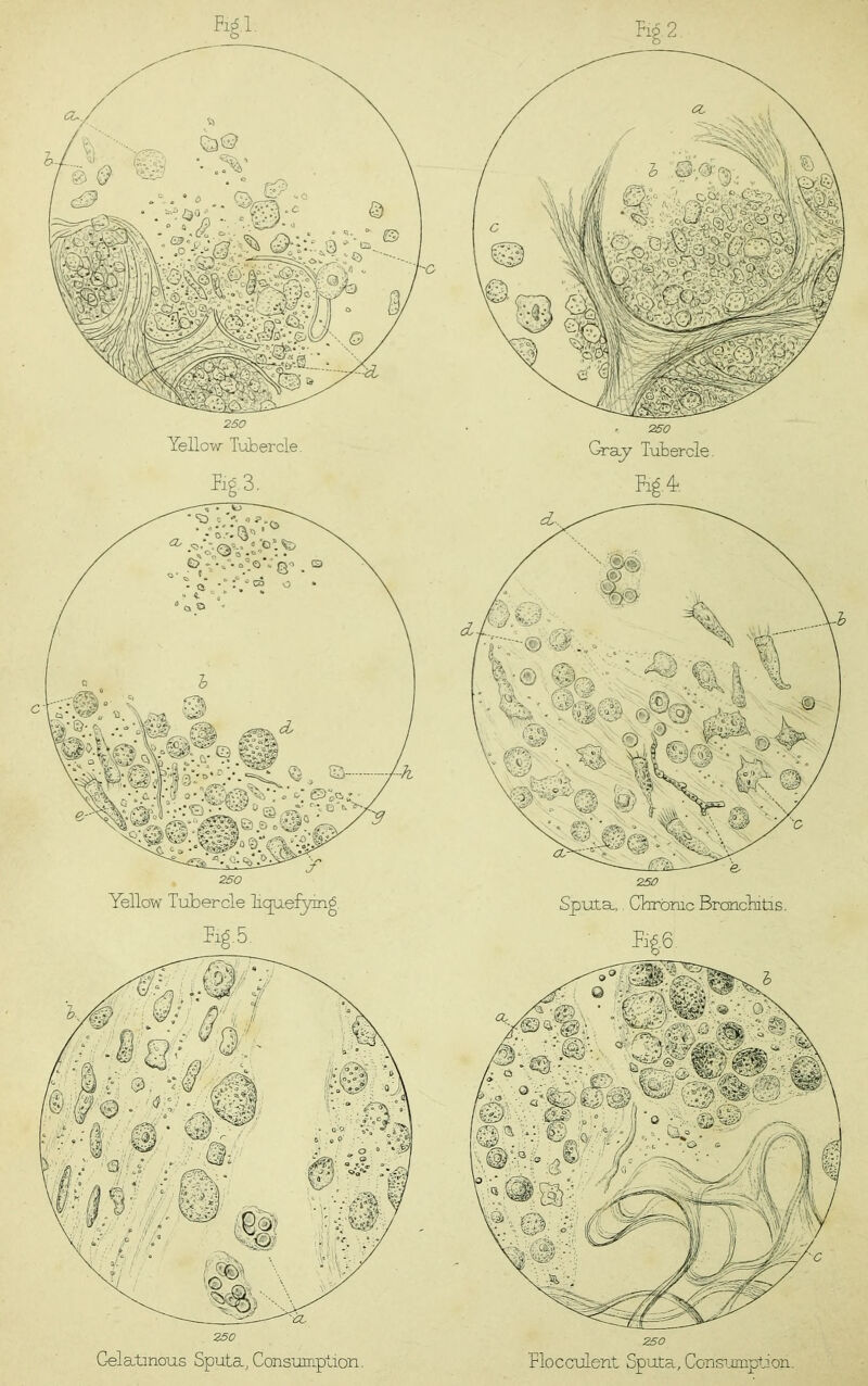 250 Yellow TiAbercle. 250 Gra^ Tubercle. Bg.3. Fig. 4. 250 Gelatinous Sputa, Consumption. 250 Flocculent Sputa, Consijmption. Yellow Tubercle bquefying. Fig.5. 250 Sputa, Chronic Brcsncbitis. Fig6.