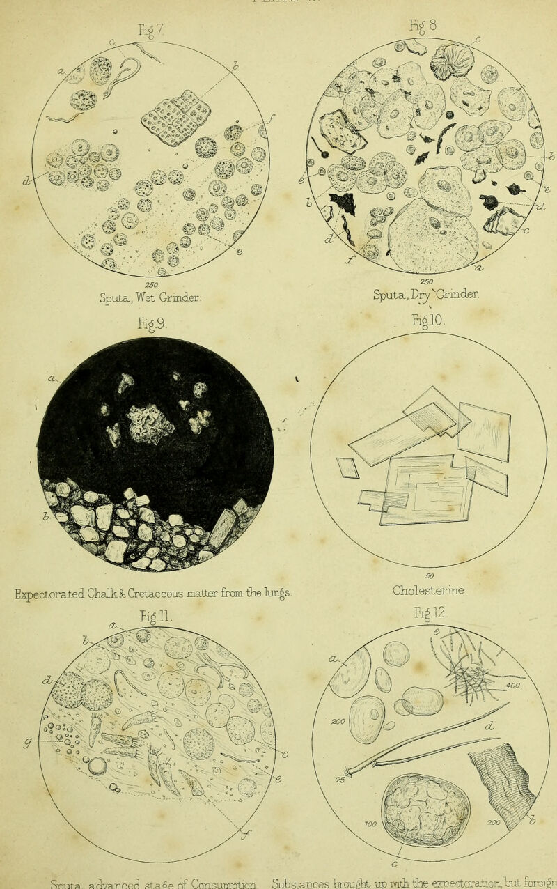 Sputa, Wet Grinder. Fig.9. Sputa, D^^GrmdeT. Srrt]t.a aSvarineS sta.pR nf ConsumiDtion. Substances orcaipTit upmtiithe 6zpectcration,bnj.tforeign Expectorated ChalkCretaceous matter from the lungs. Cholesterine. . Kgl2