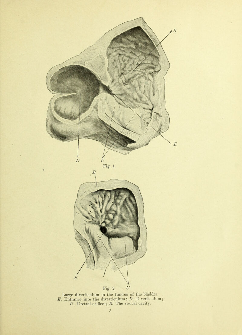 Fig. 2 U Large diverticulum in the fundus of the bladder. E. Entrance into the diverticulum; D. Diverticulum; U. Uretral orifices; B. The vesical cavity.