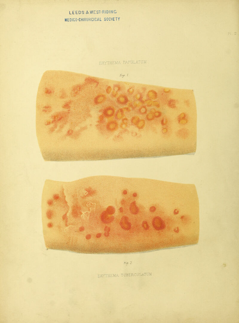 MEDICO-CHIRURGICAL SOCIETY ERYTHEMA PAFULATUM . ncf.Z. ERYTHEMA TUBERCULATUM