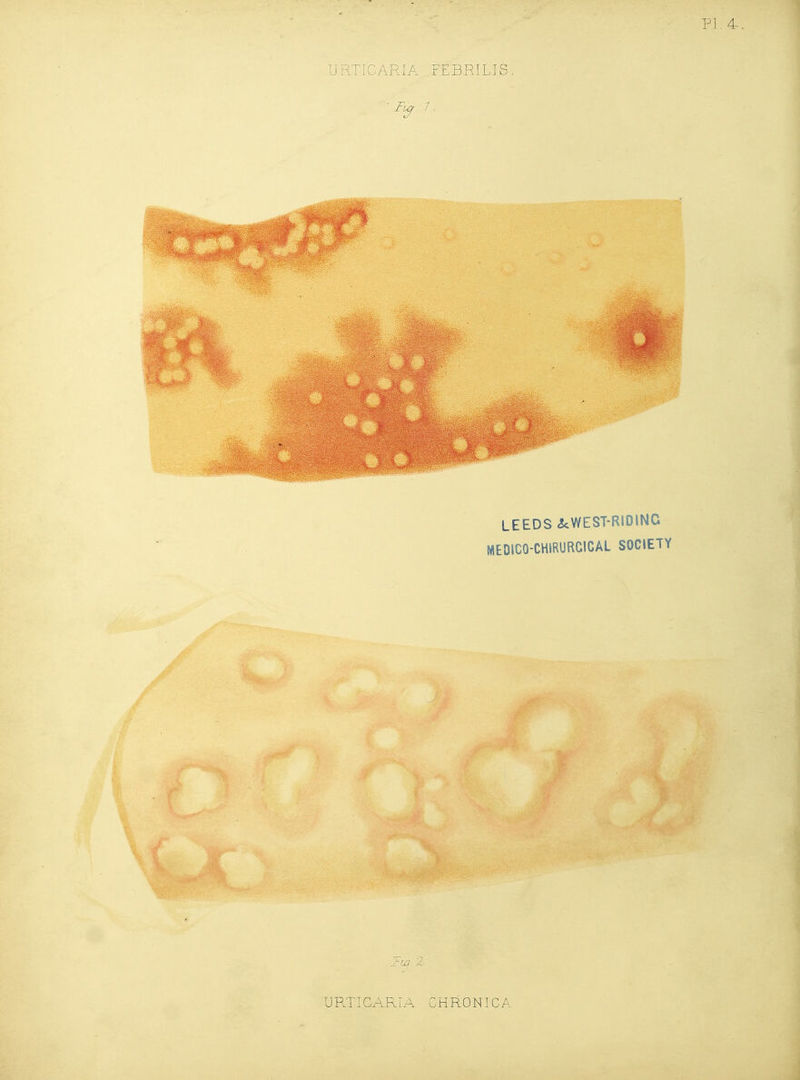 PI.4, URTICARIA FEBRILIS ' Fia - / . LEEDS ^cWEST-RIDINC NIEDICO-CHIRURCICAL SOCIETY ^TW X,' UPJTICARLIA CHRONICA